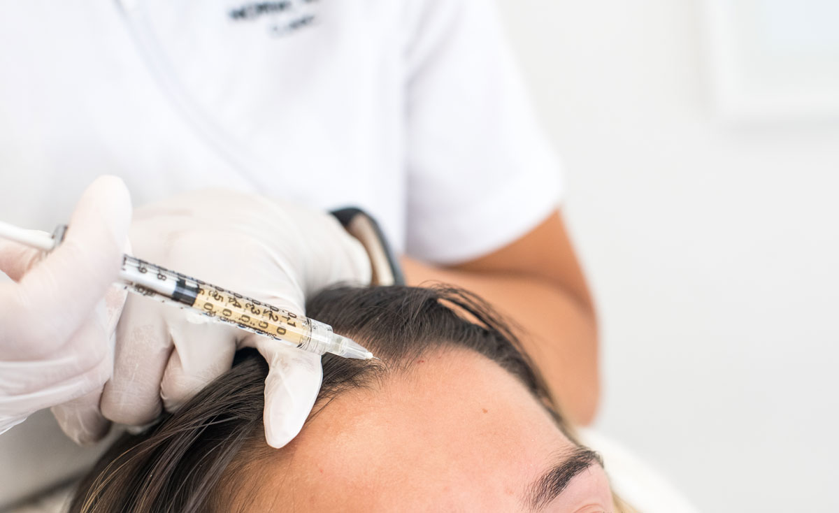 En kvinna får efterbehandling med PRP efter sin hårtransplantation