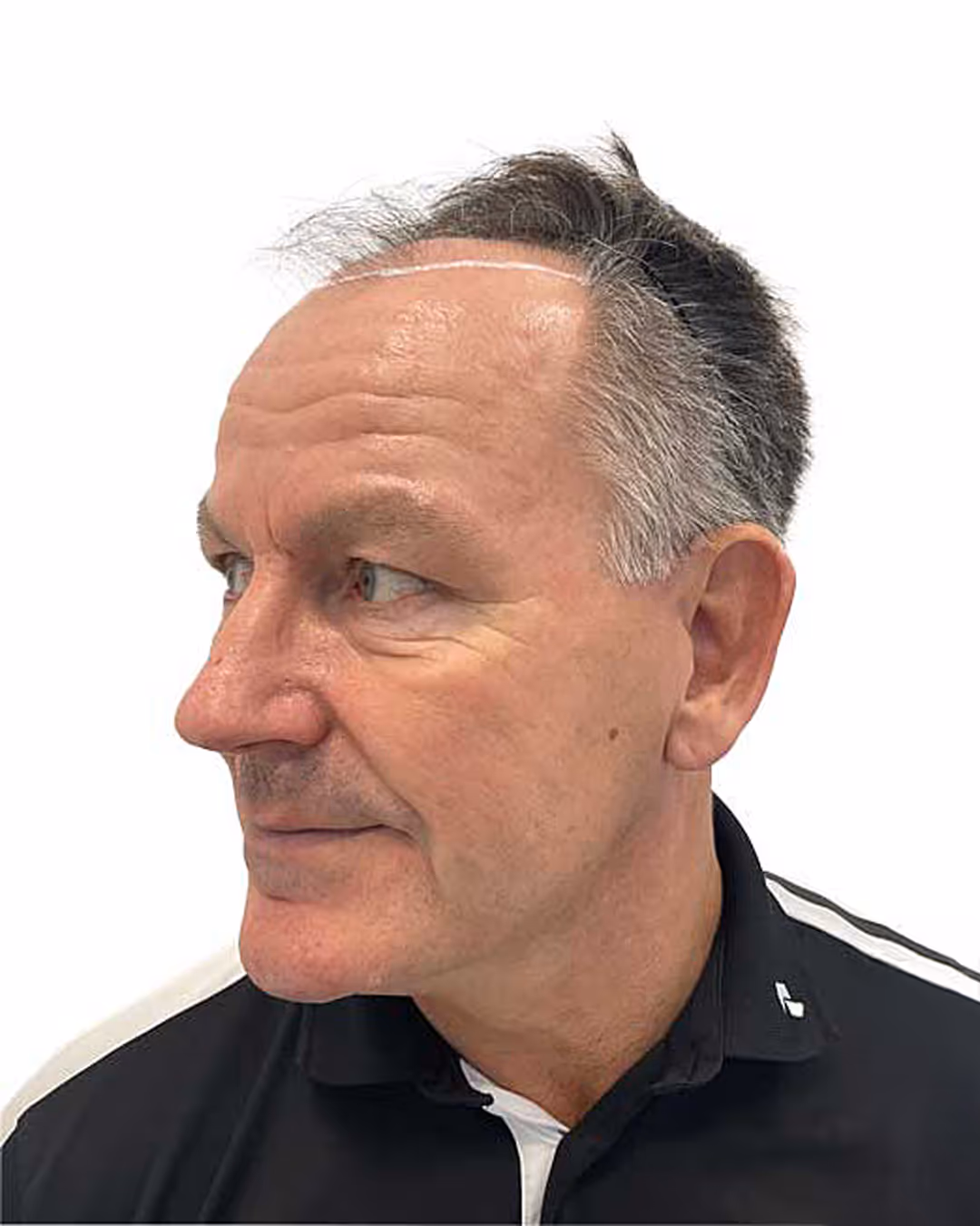 Rene före hårtransplantationen