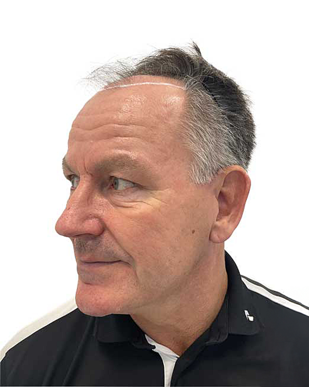 Rene före hårtransplantationen