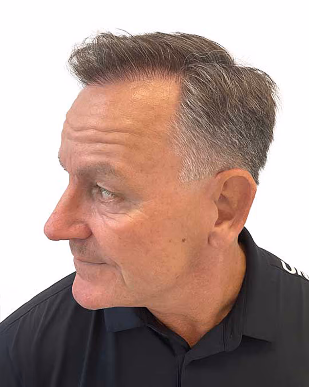 Rene efter hårtransplantationen