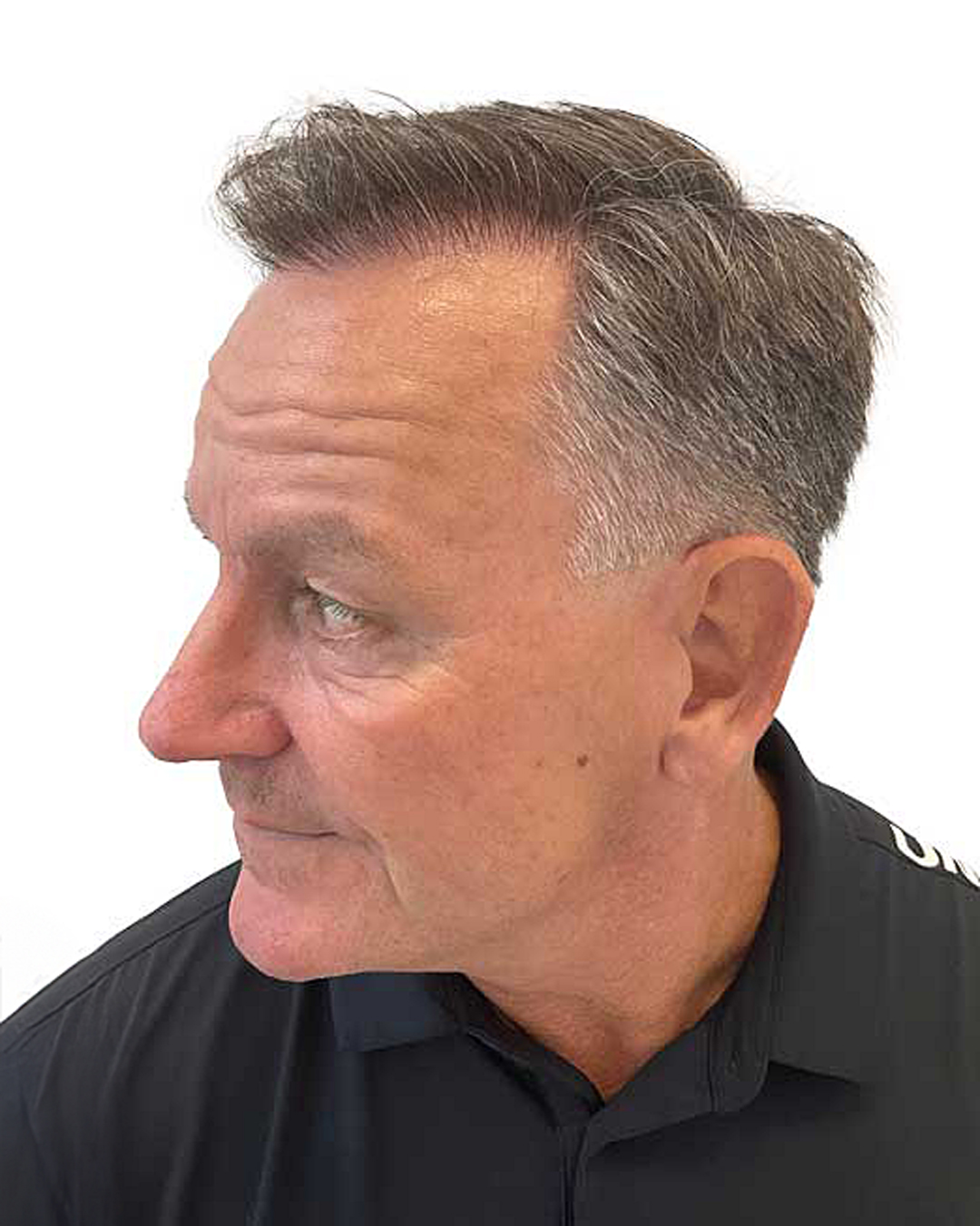 Rene efter hårtransplantationen