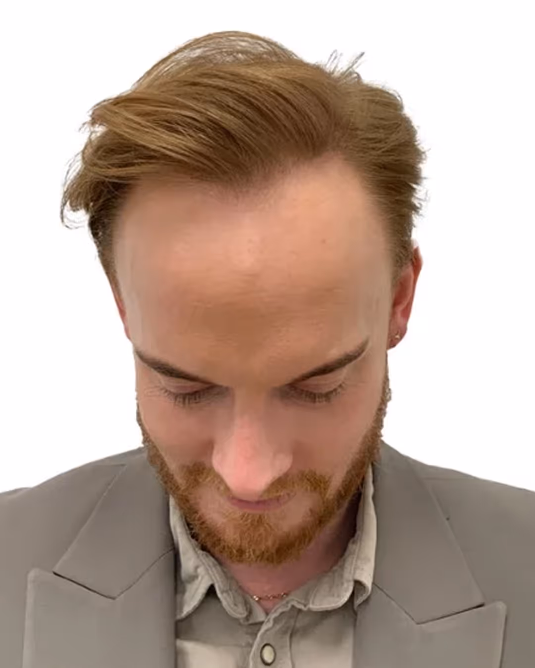 Simon efter hårtransplantationen