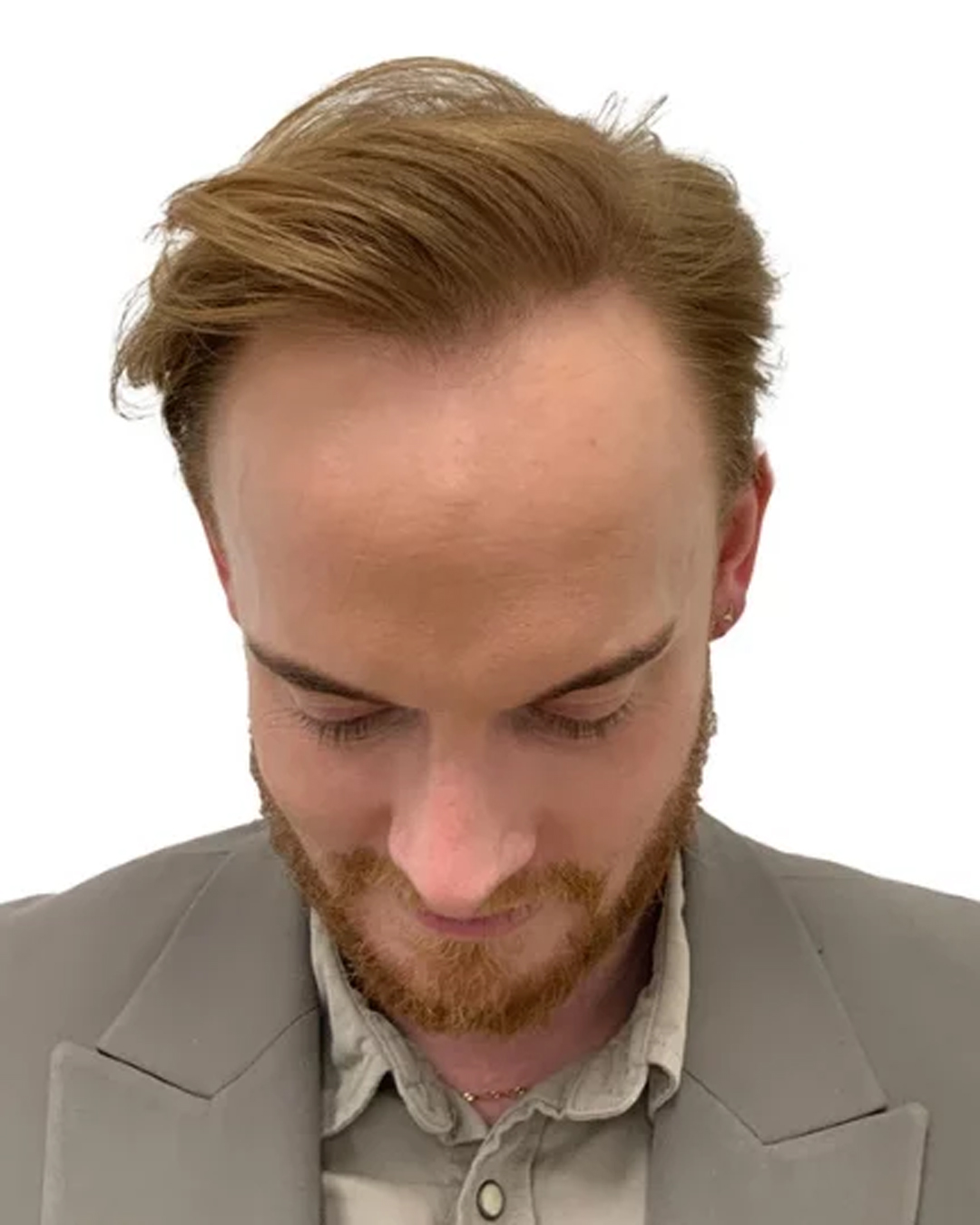 Simon efter hårtransplantationen