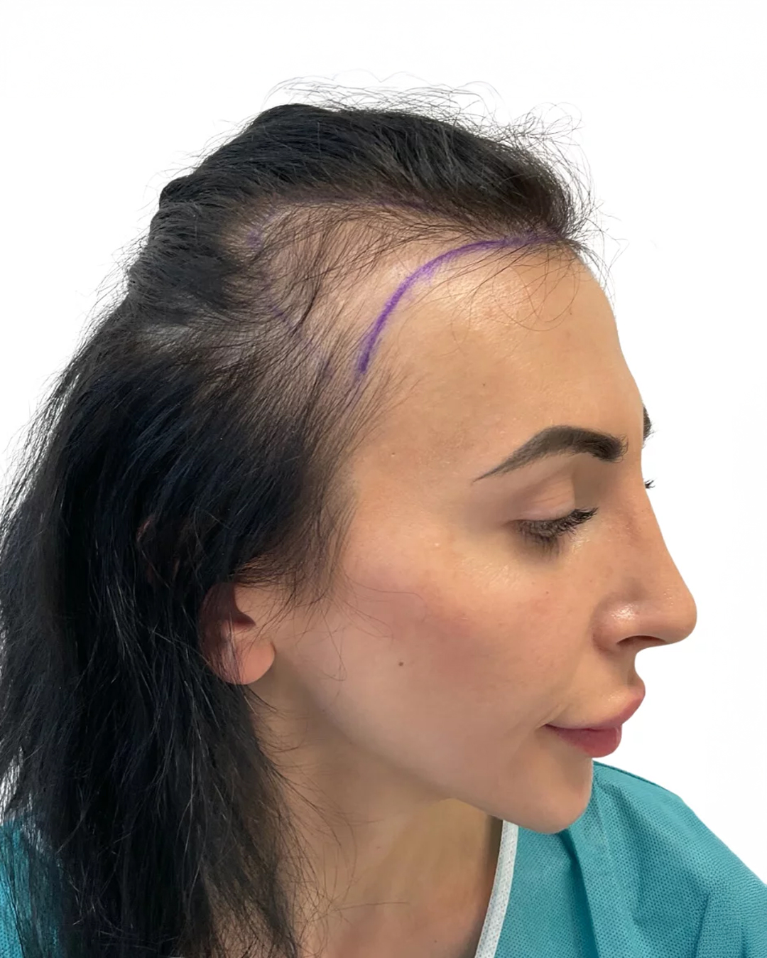 Ines före hårtransplantationen