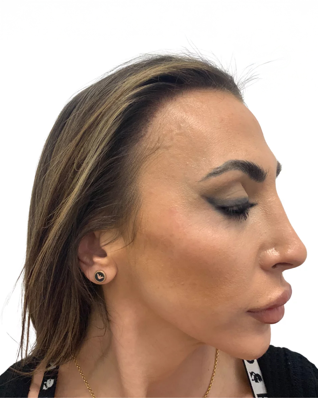 Ines efter hårtransplantationen