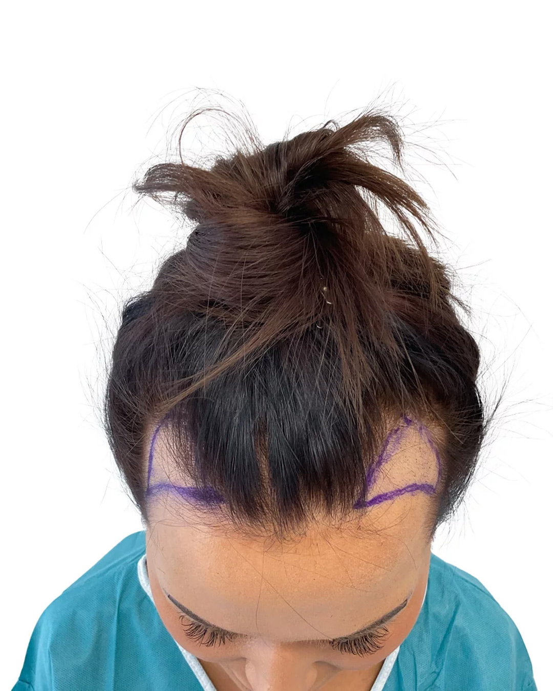 Viktoria före hårtransplantationen