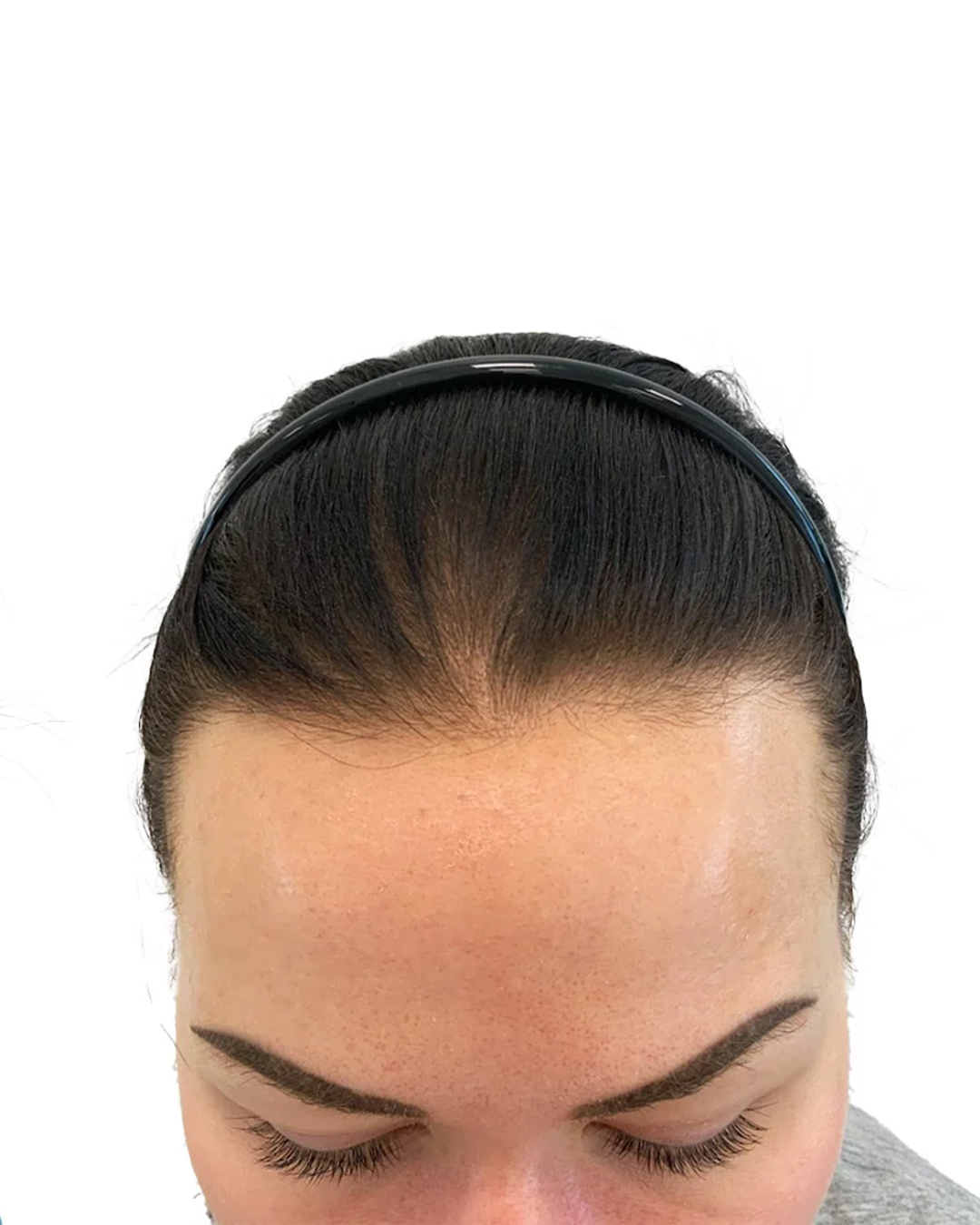 Viktoria efter hårtransplantationen