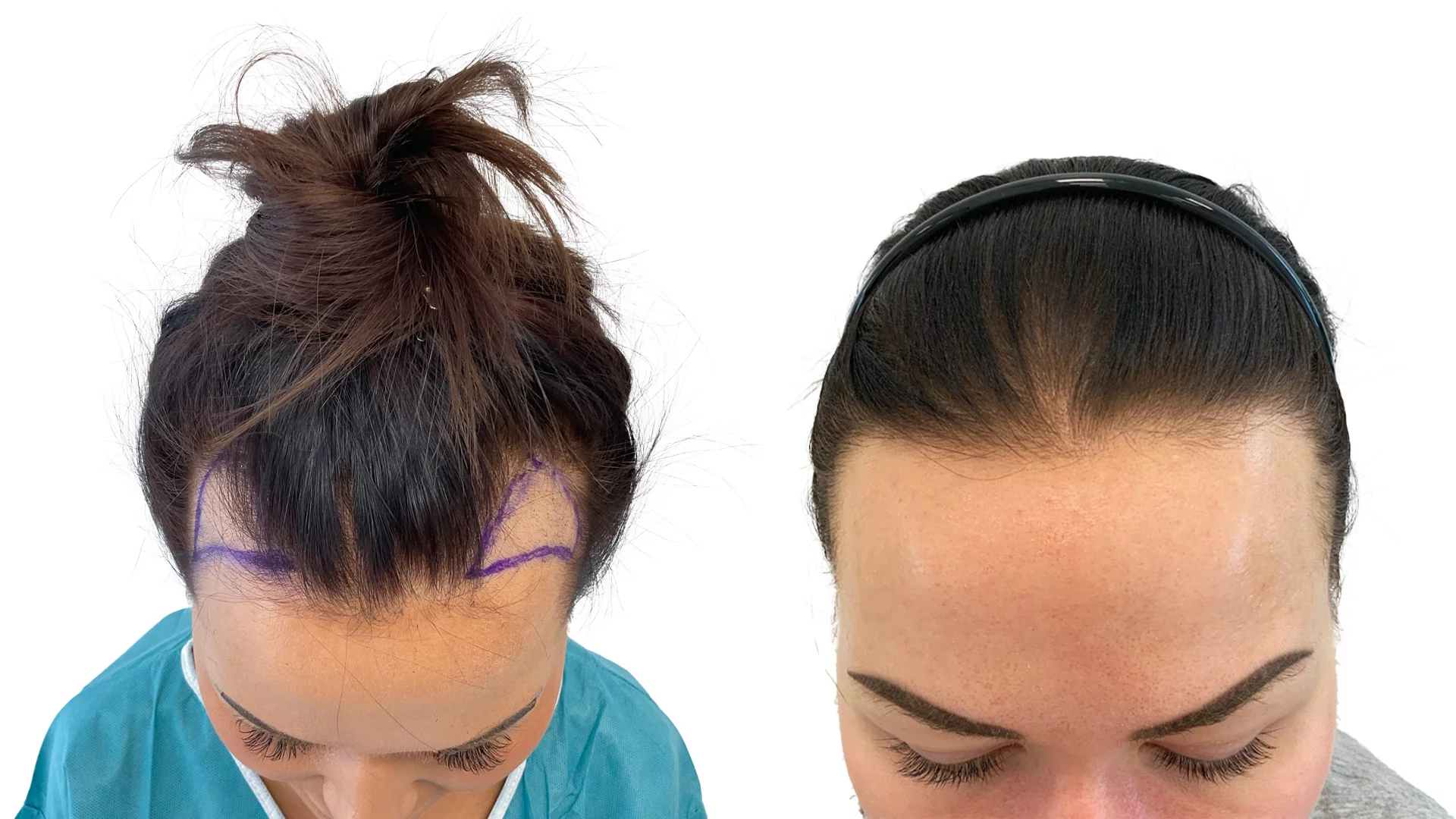 Victoria – före och efter sin hårtransplantation