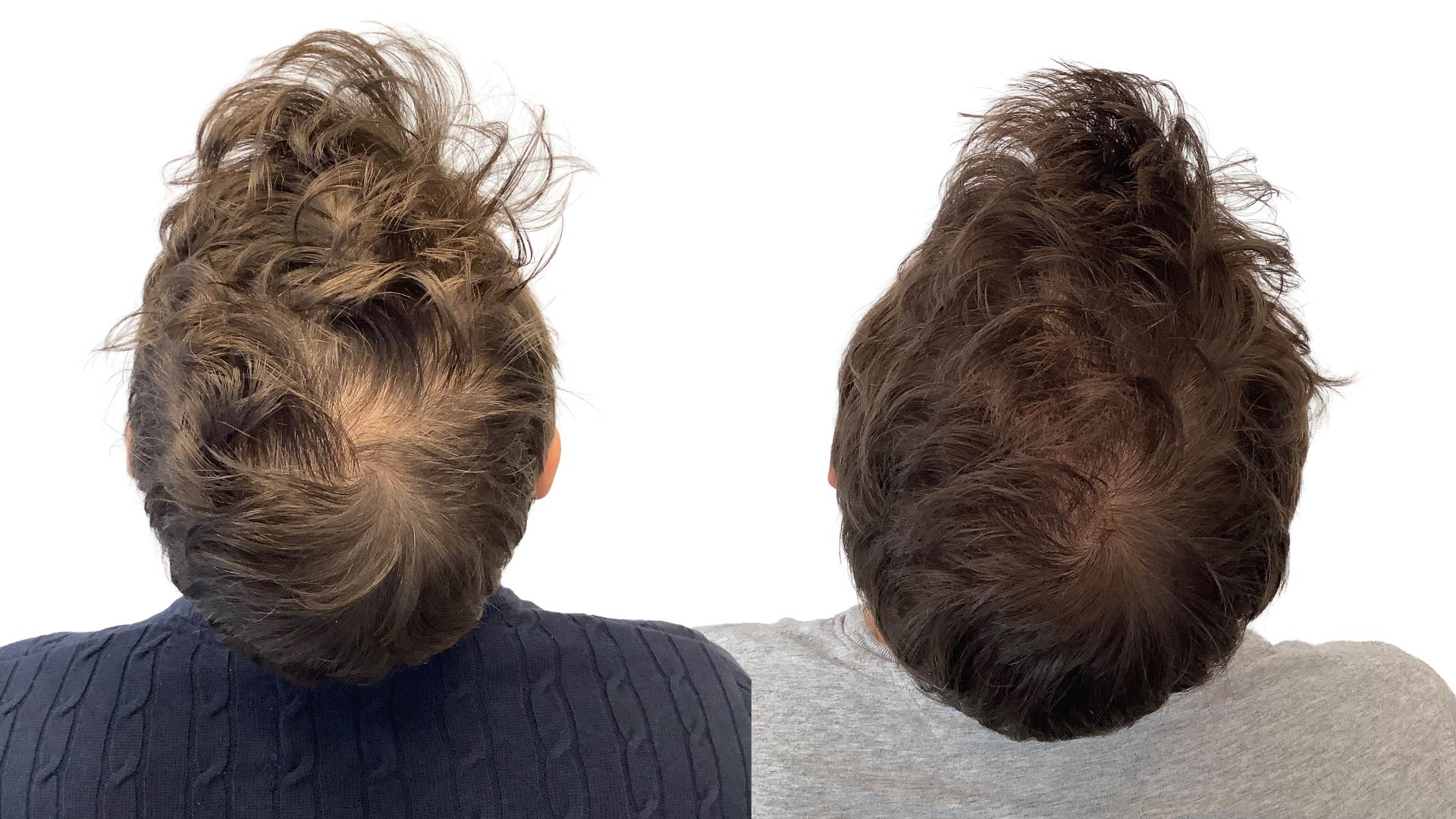 Valentin – före och efter sin hårbehandling