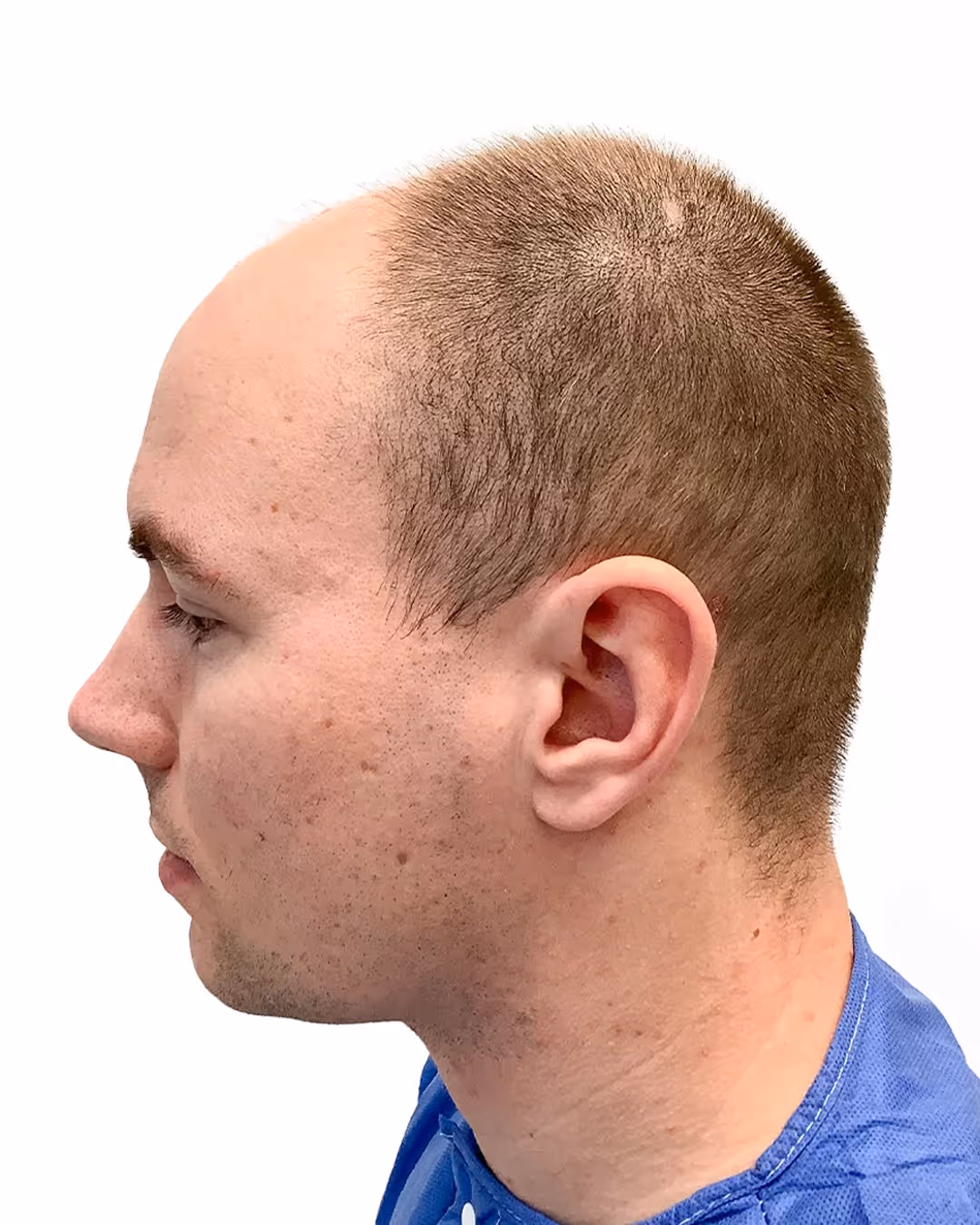 Tobias före hårtransplantationen