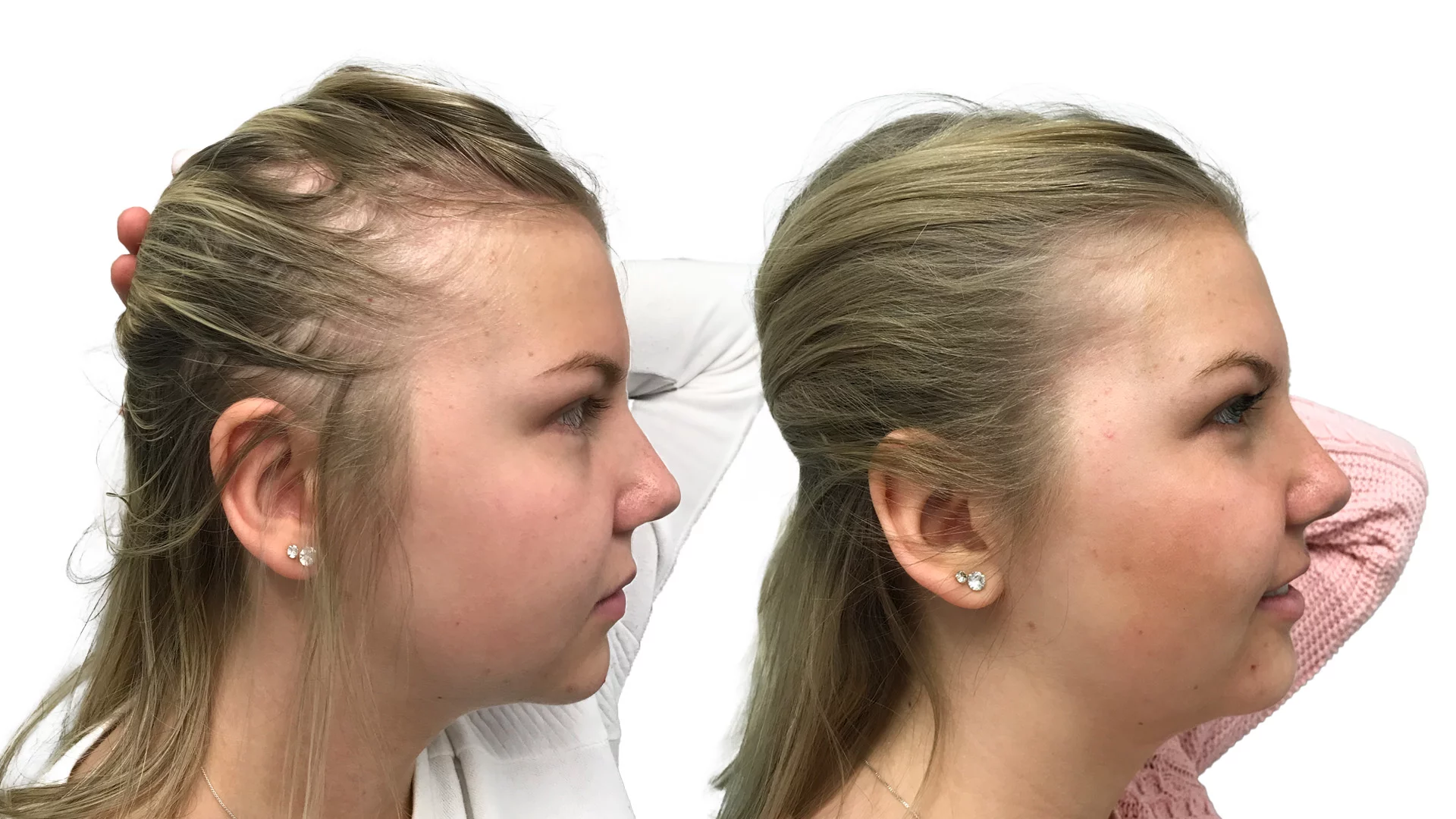 Thilda – före och efter sin hårbehandling