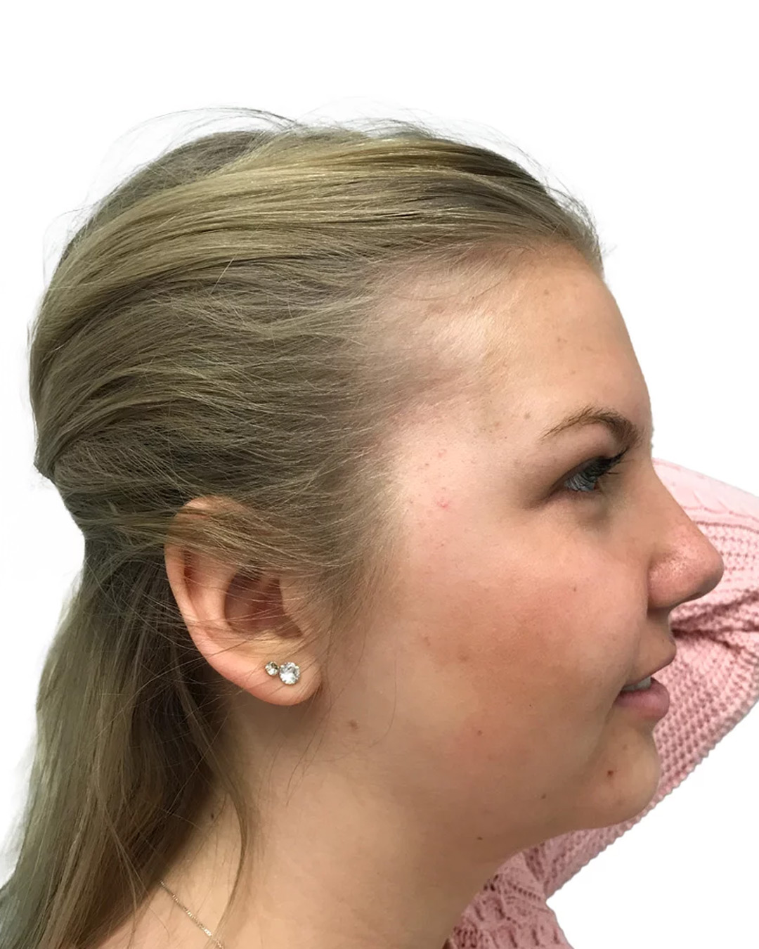 Thilda efter hårbehandlingen