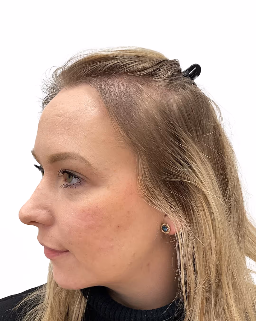 Therese efter hårtransplantationen