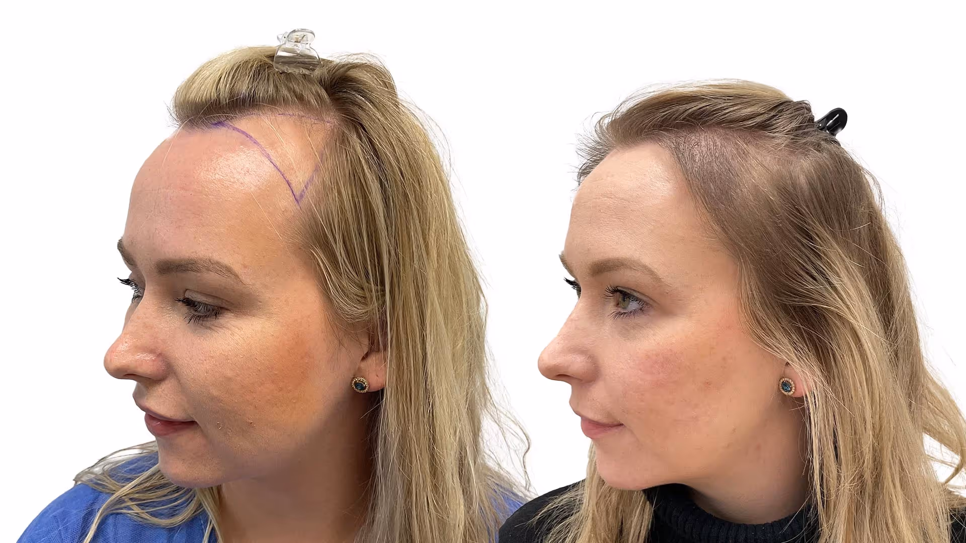 Therese – före och efter sin hårtransplantation