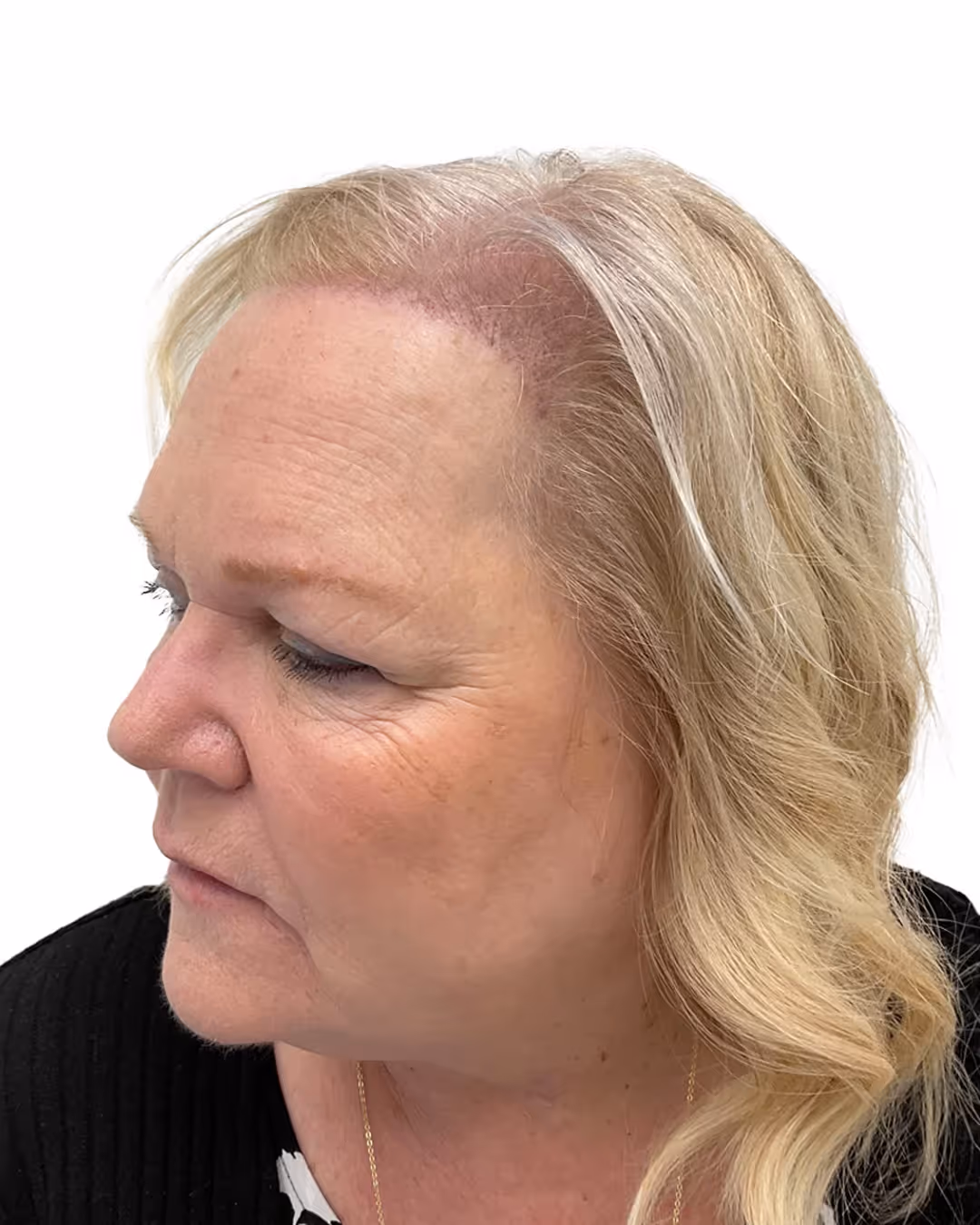 Susanne efter hårtransplantationen