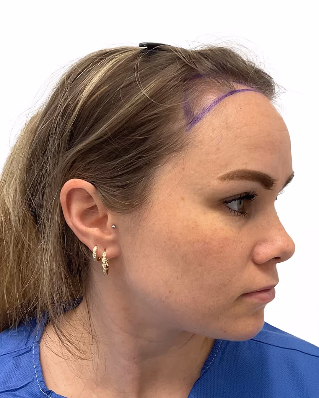 Sofia före hårtransplantationen