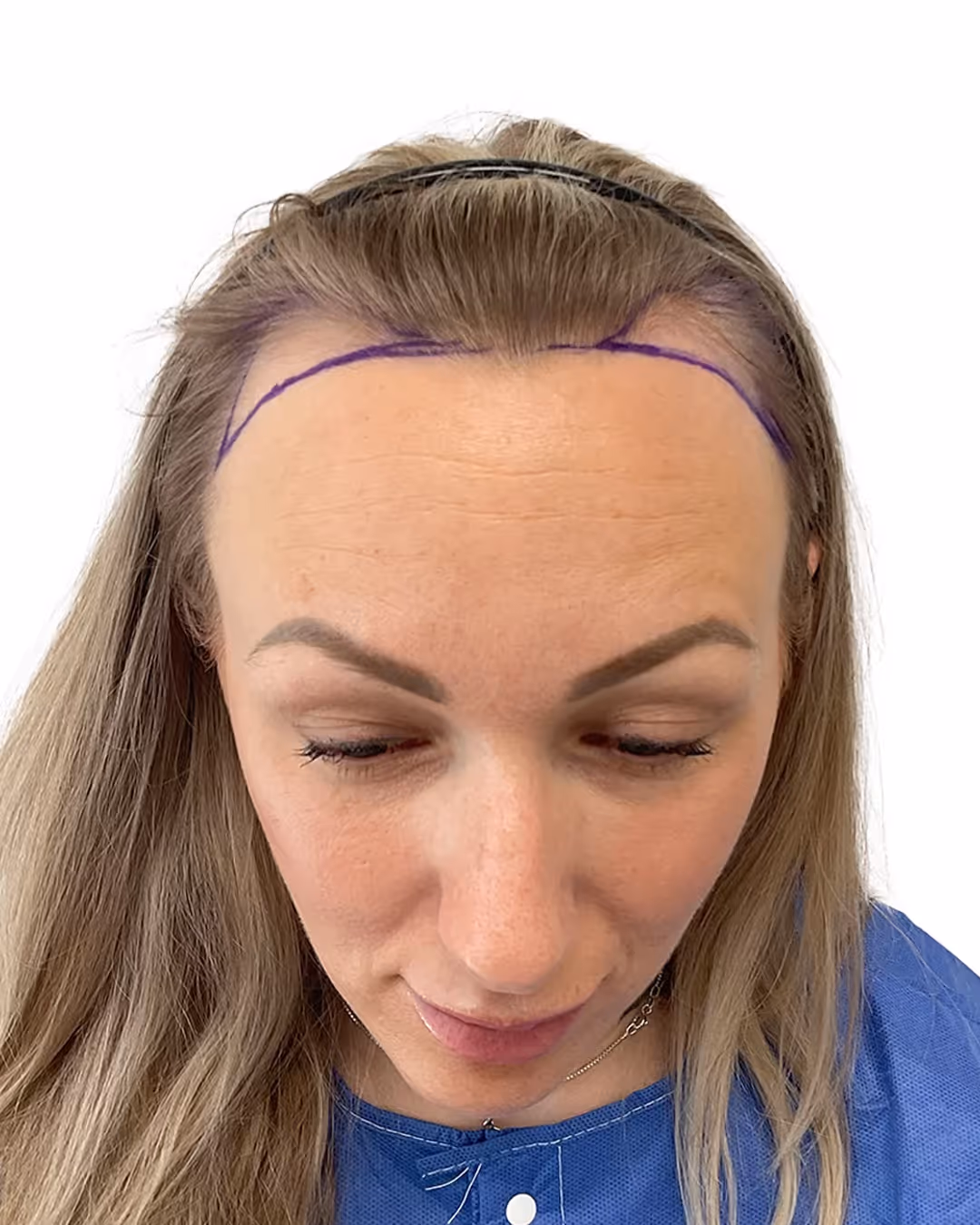 Sandra före hårtransplantationen