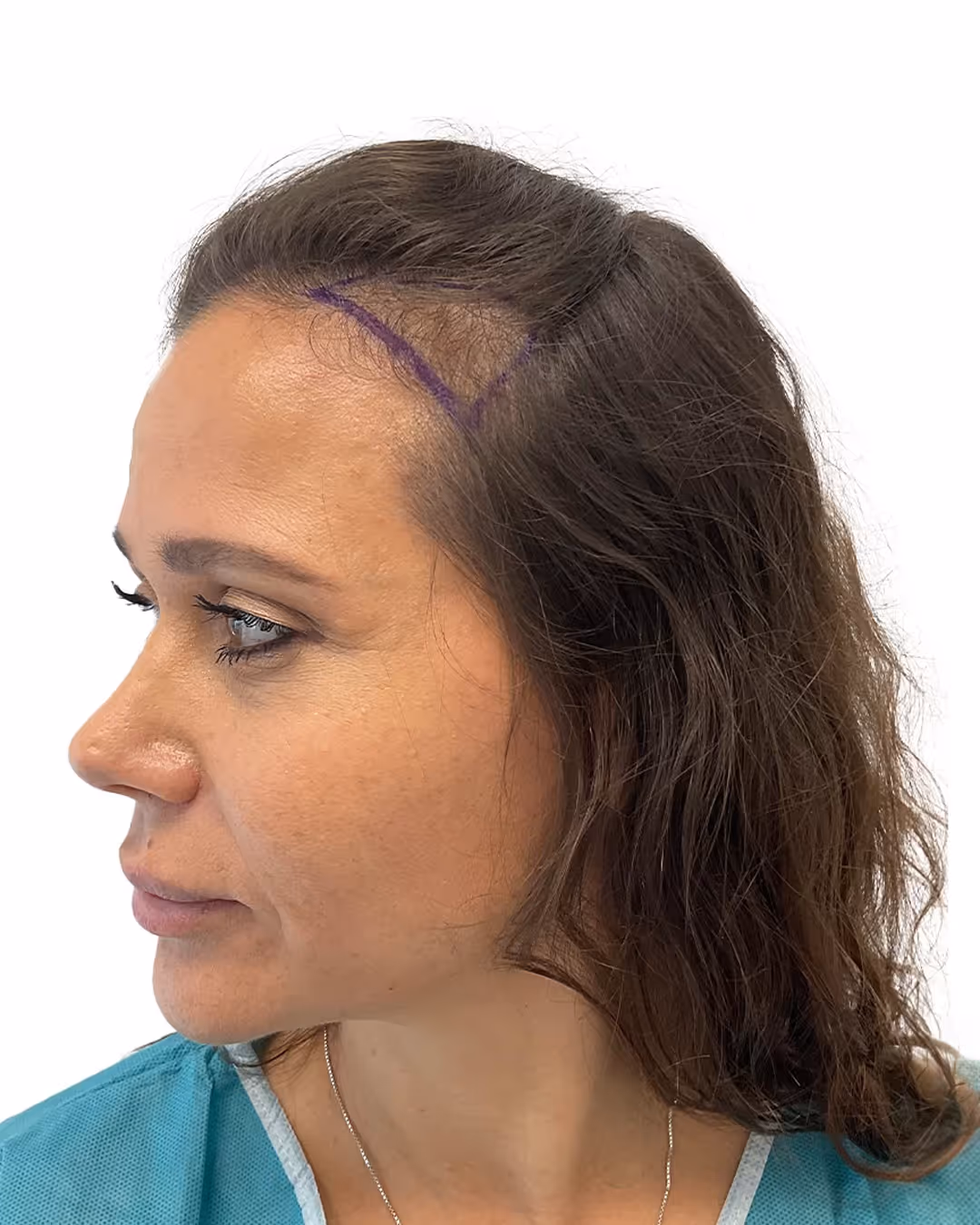 Sandra före hårtransplantationen