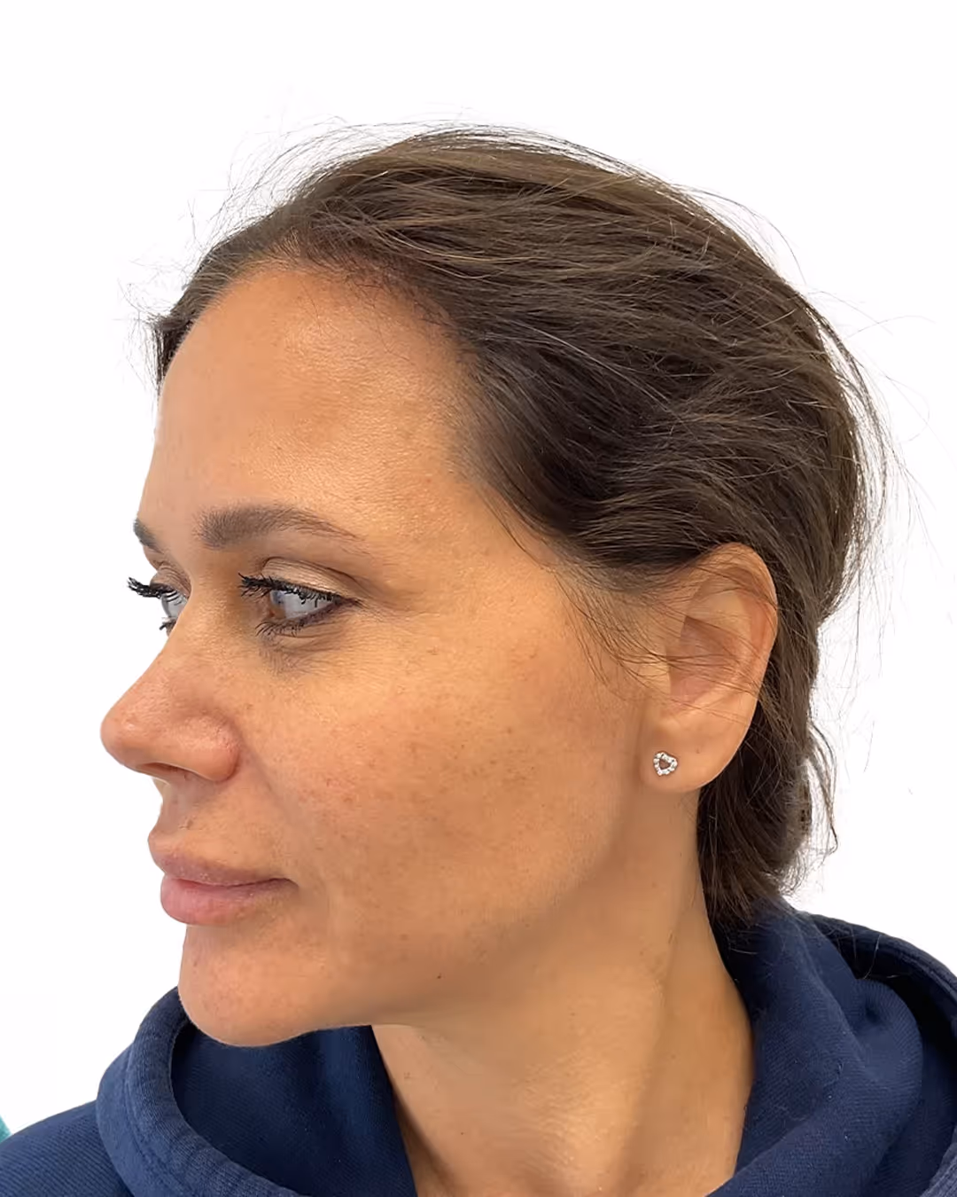 Sandra efter hårtransplantationen
