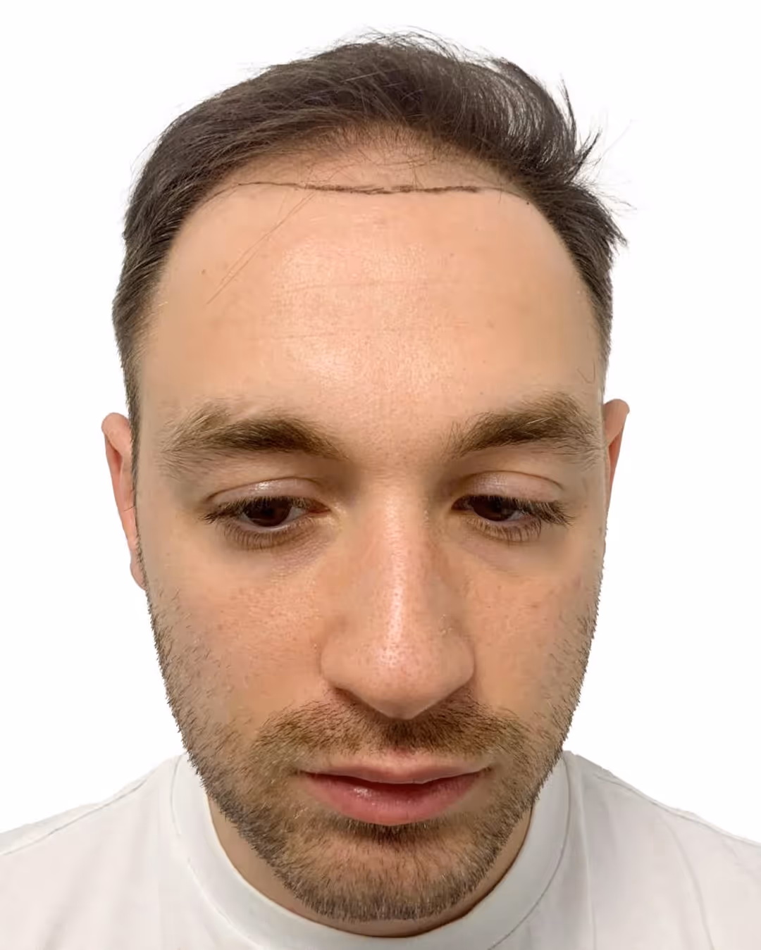 Robert före hårtransplantationen