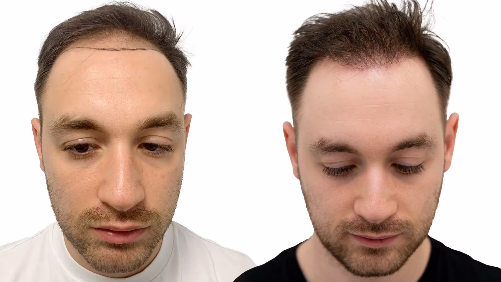 Robert – före och efter sin hårtransplantation