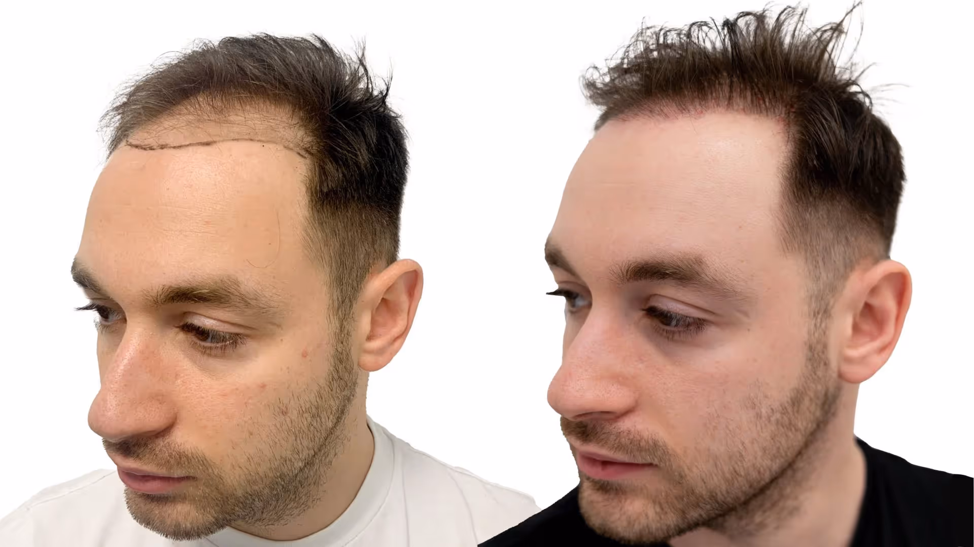 Robert – före och efter sin hårtransplantation