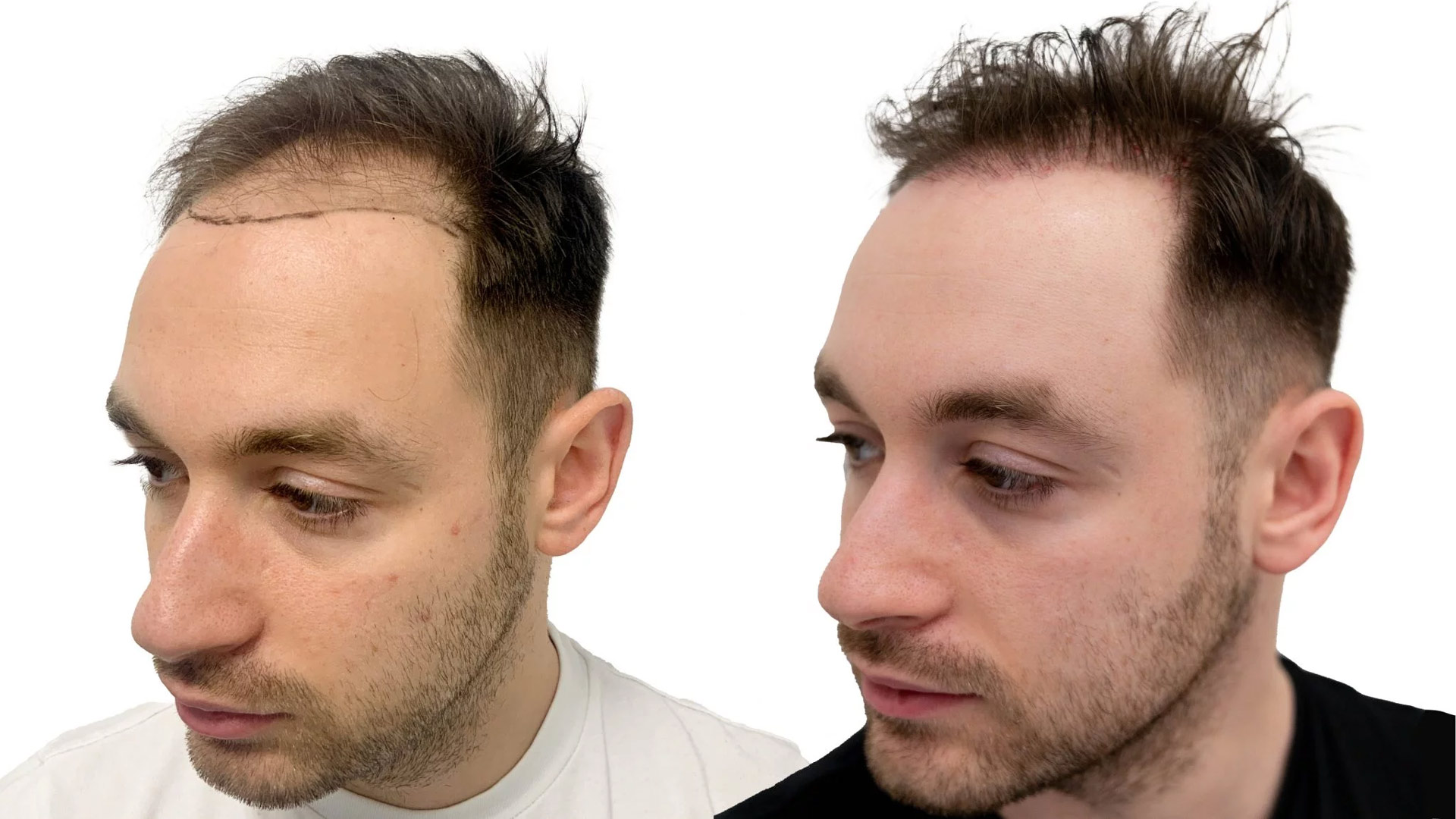 Robert – före och efter sin hårtransplantation