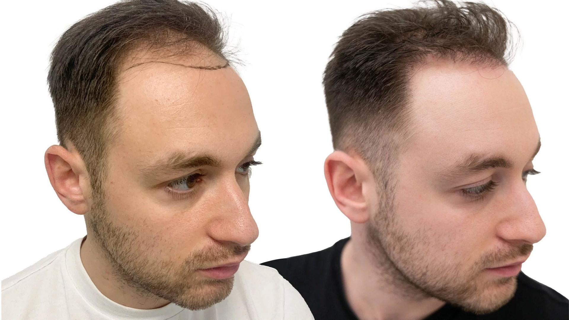 Robert – före och efter sin hårtransplantation