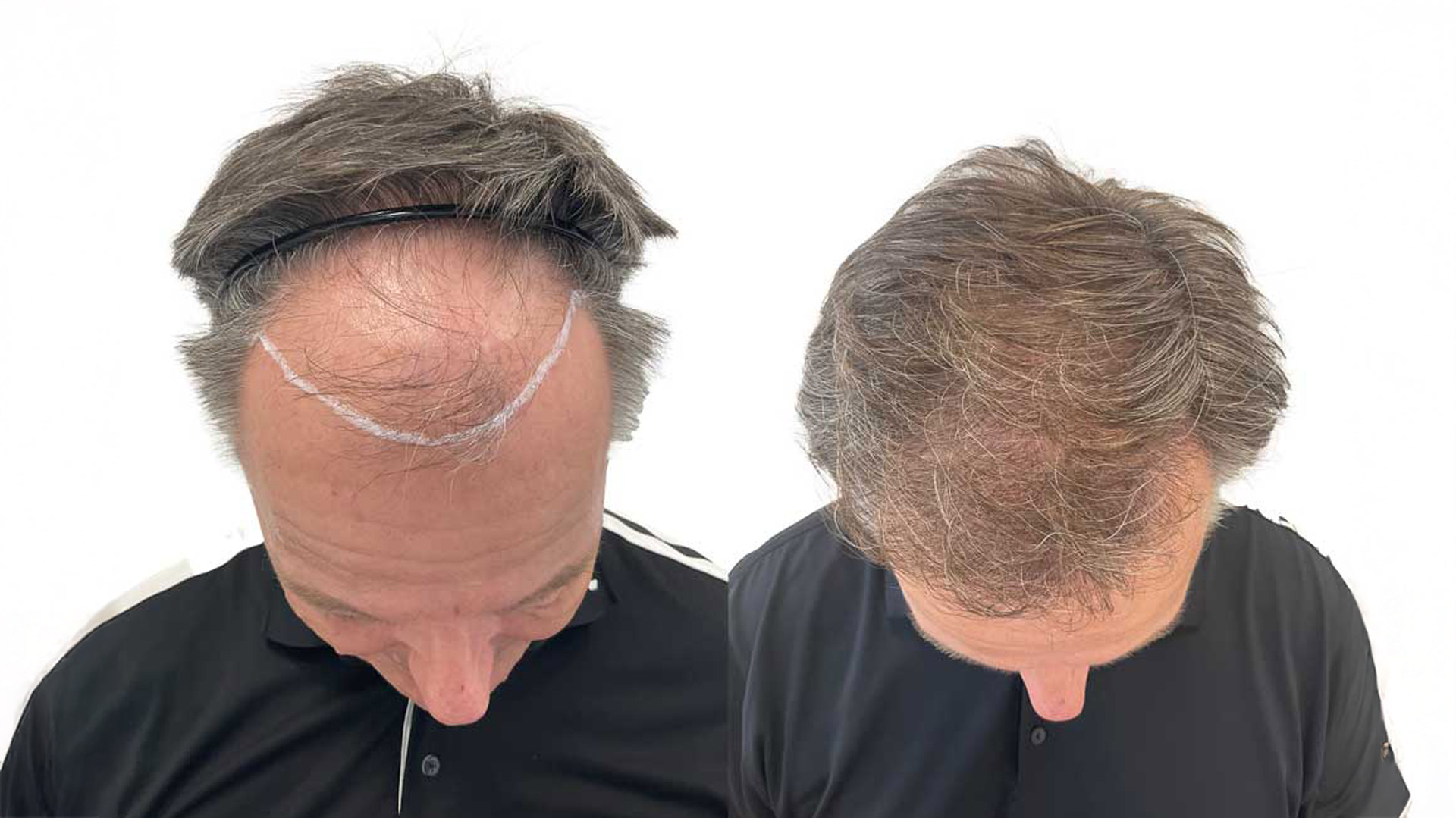 Rene – före och efter sin hårtransplantation