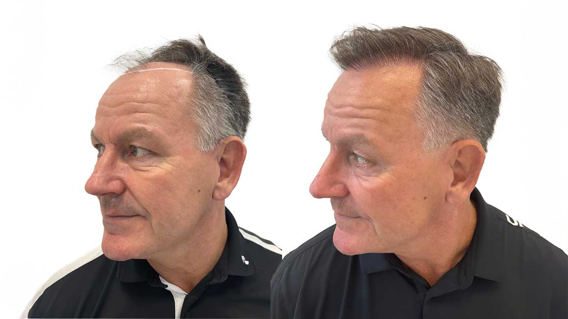 Rene – före och efter sin hårtransplantation