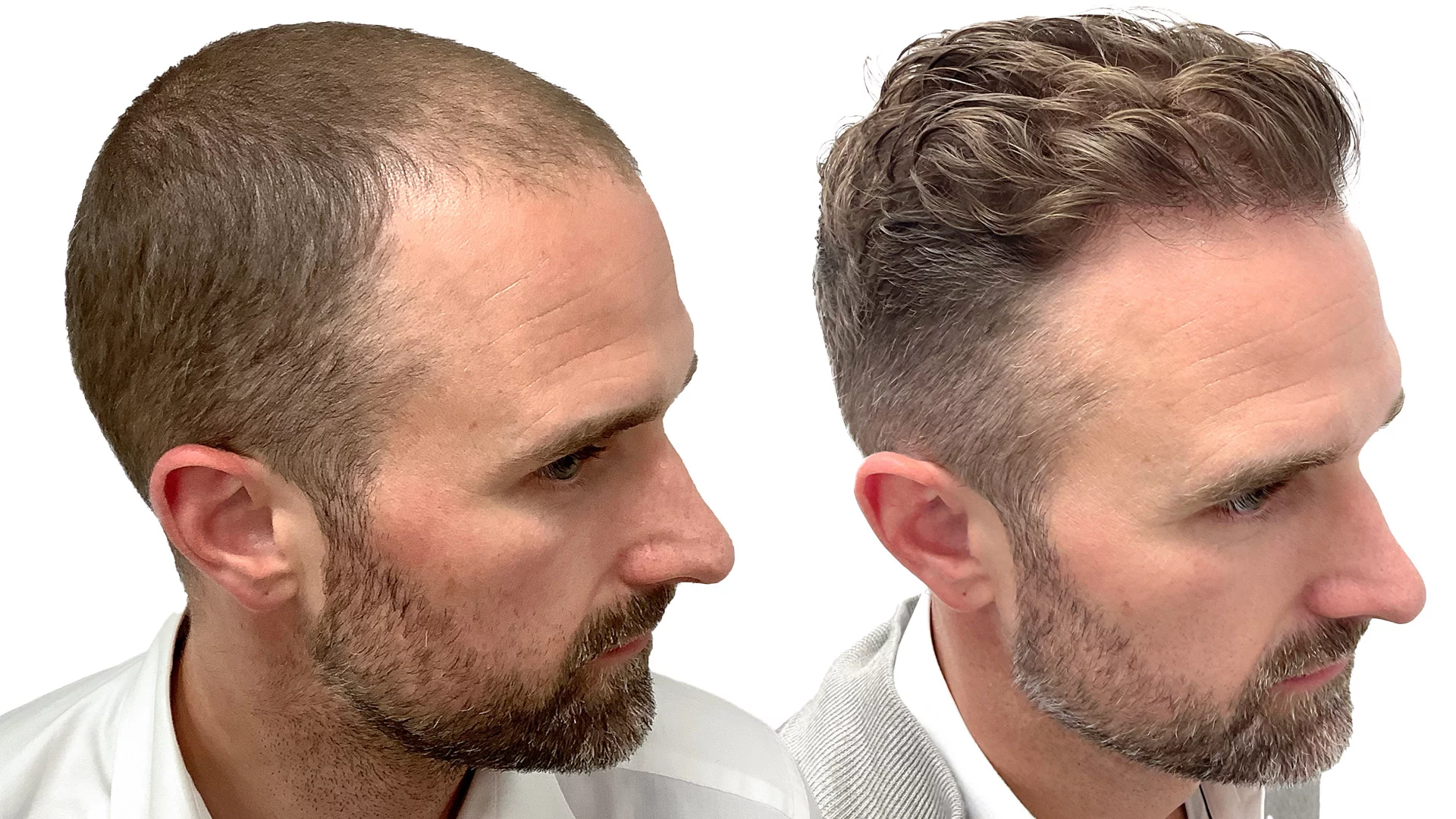 Pontus – före och efter sin hårtransplantation