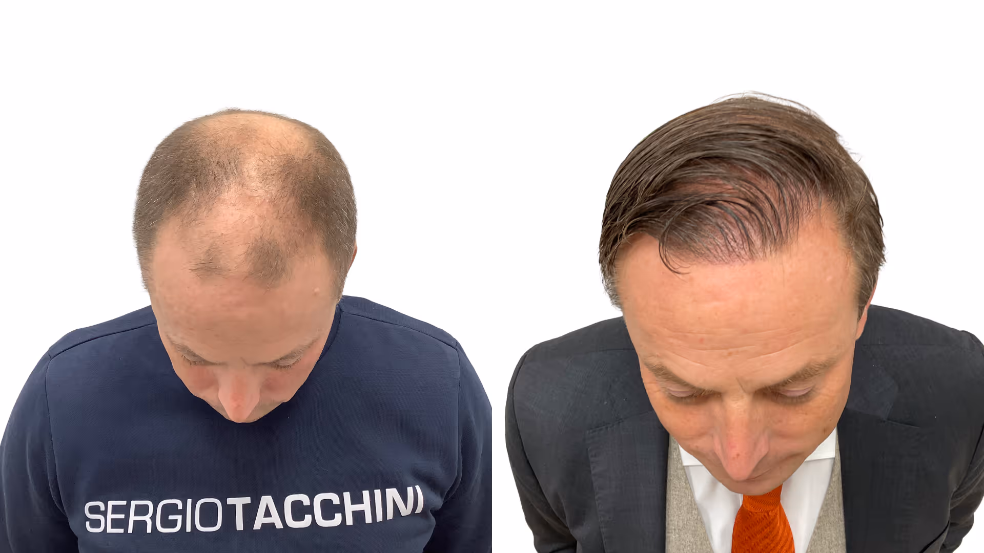 Per – före och efter sin hårtransplantation