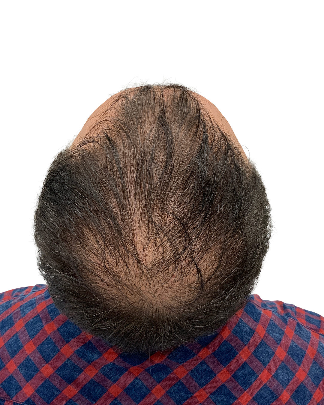 Massimo efter hårtransplantationen