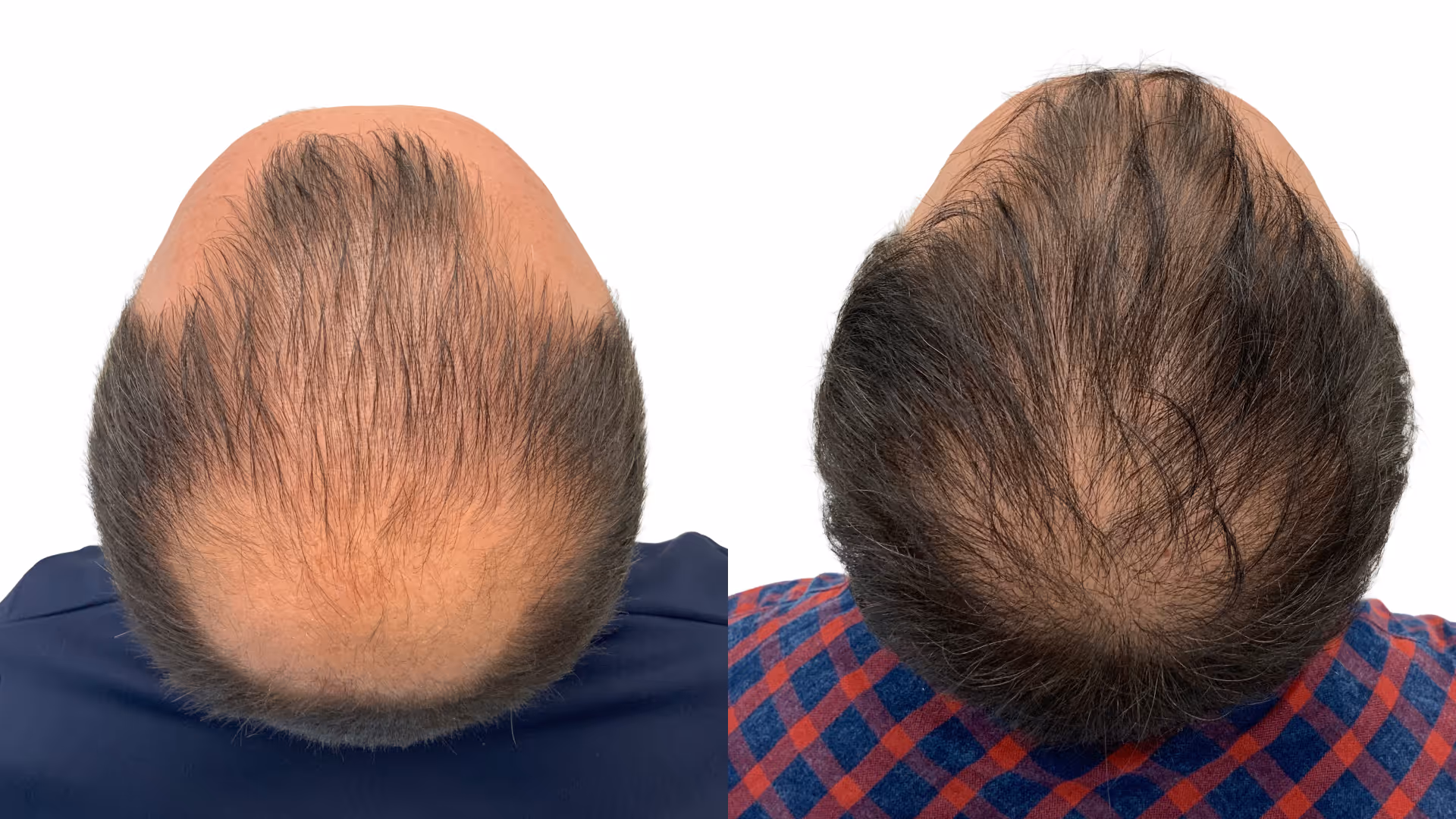 Massimo – före och efter sin hårtransplantation