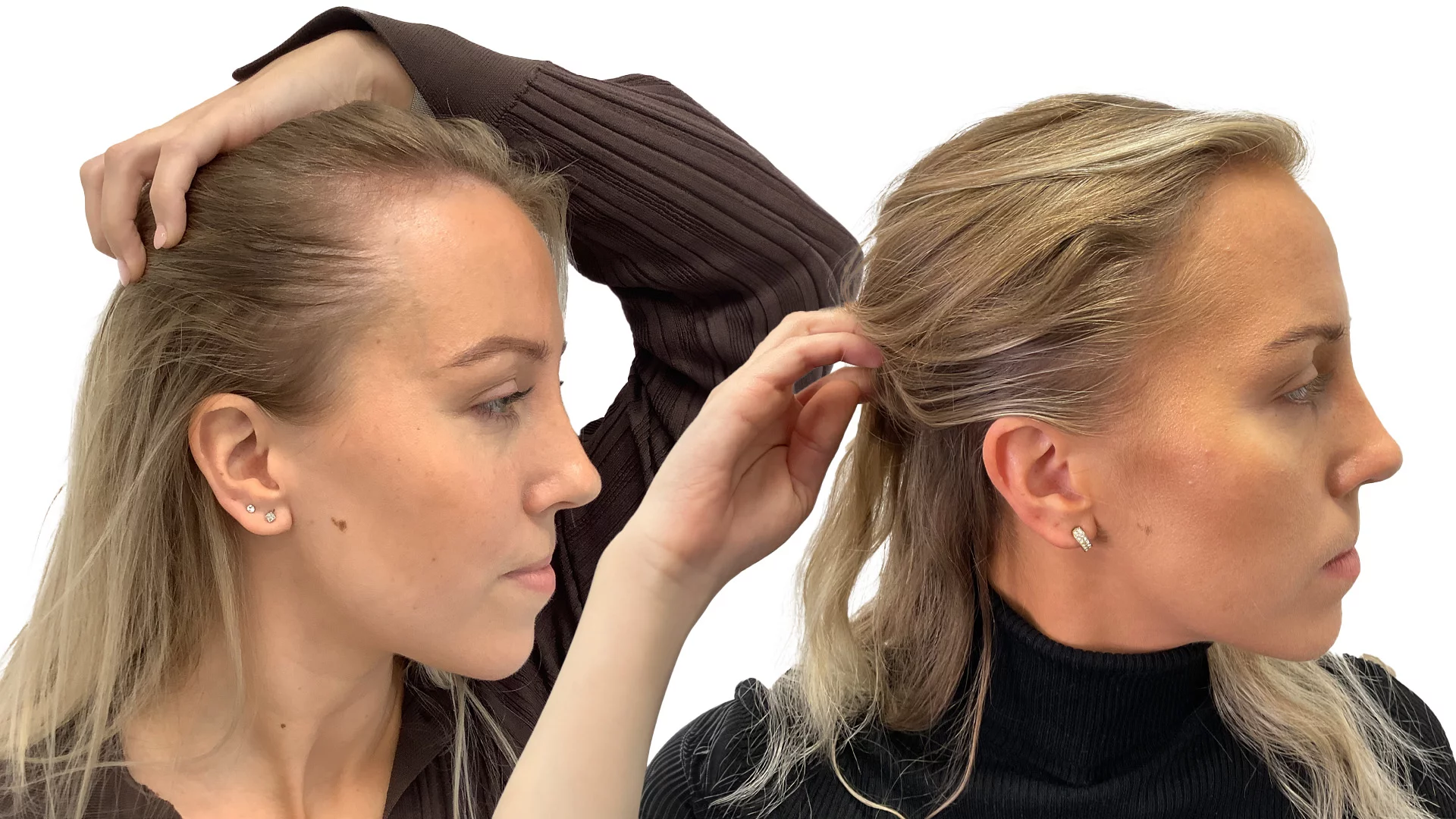 Martina – före och efter sin hårtransplantation