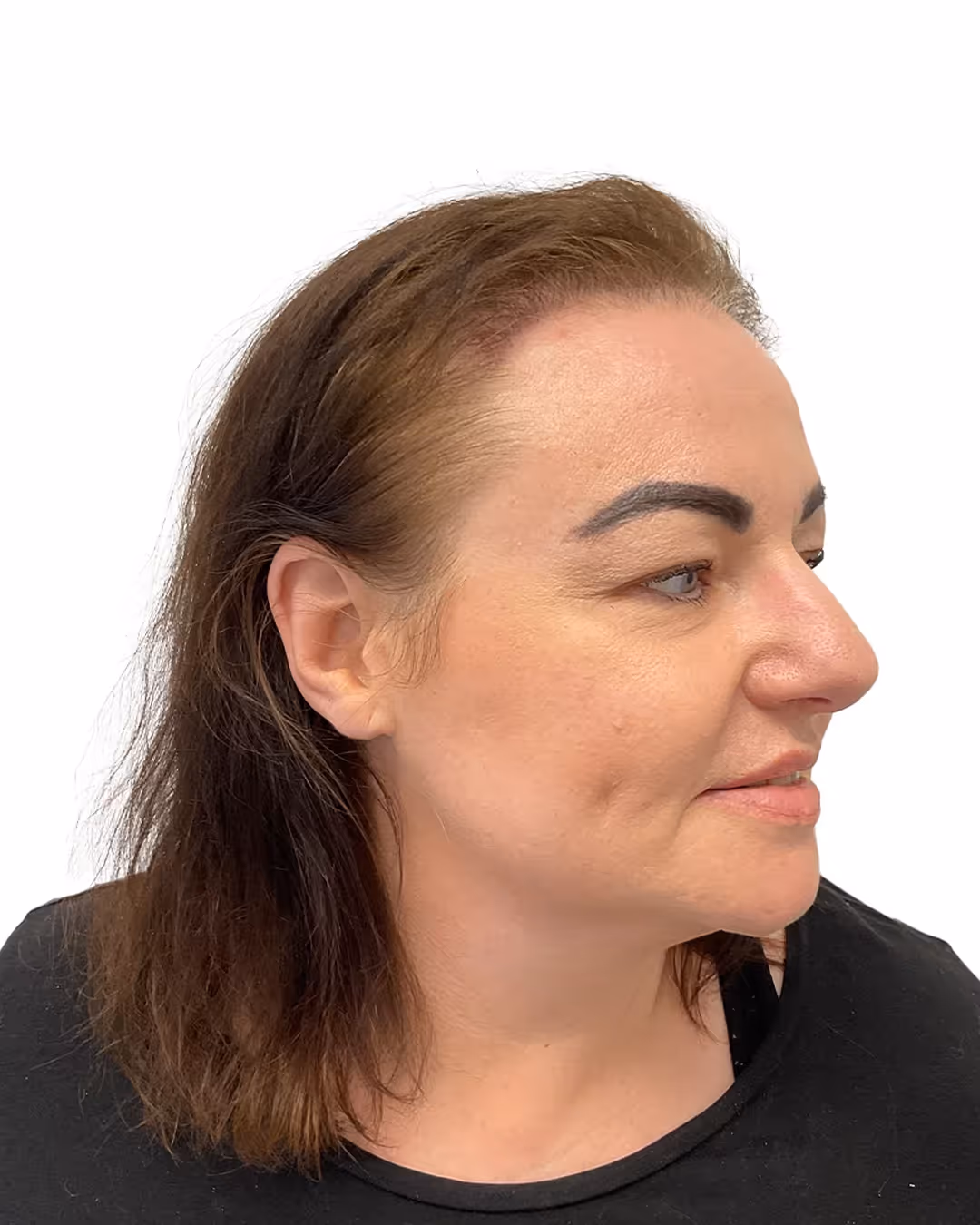 Malou efter hårtransplantationen