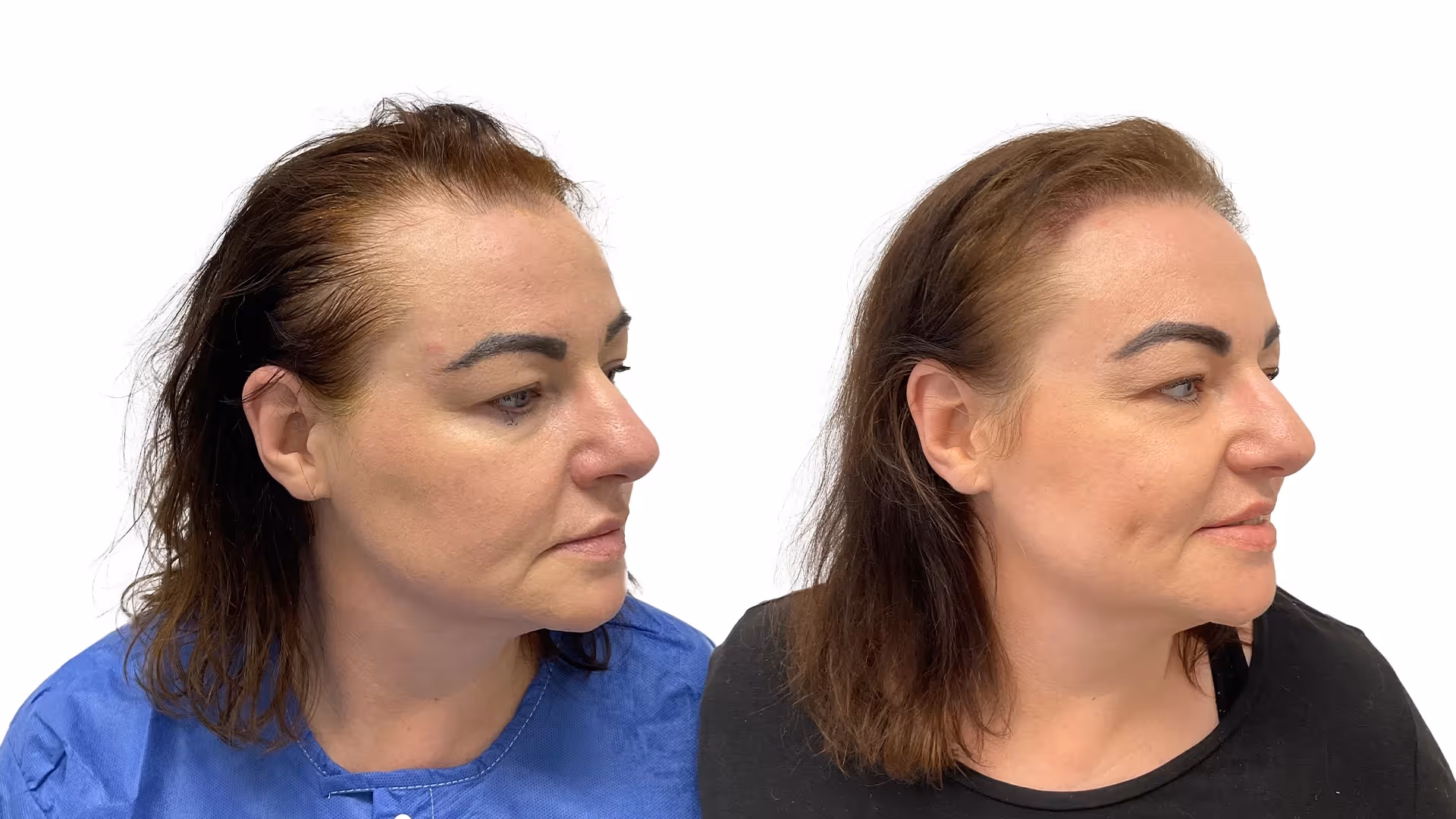 Malou – före och efter sin hårtransplantation