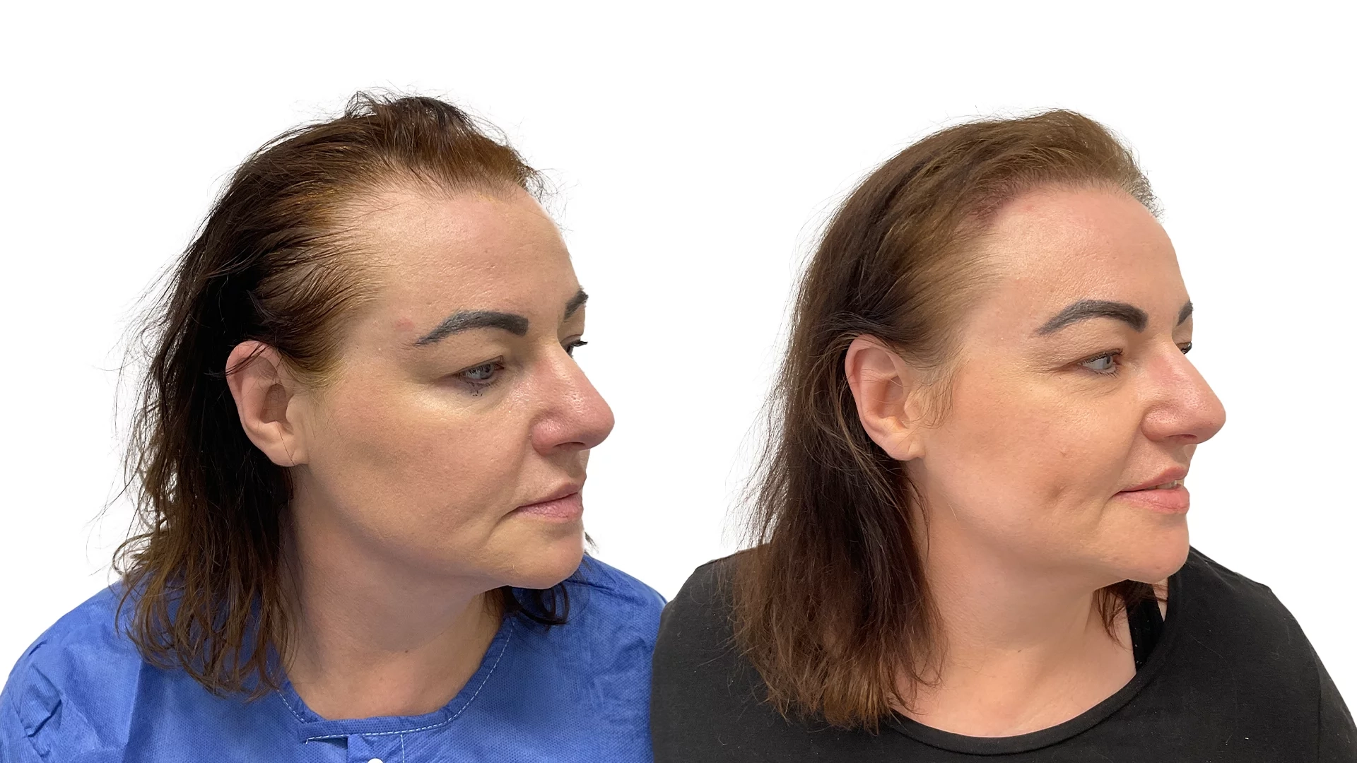 Malou – före och efter sin hårtransplantation