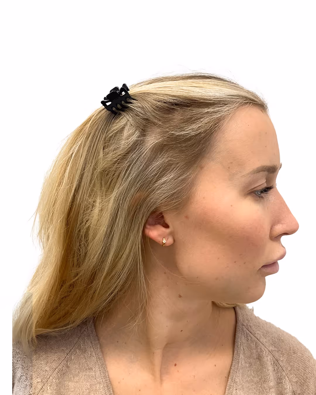 Malin efter hårtransplantationen