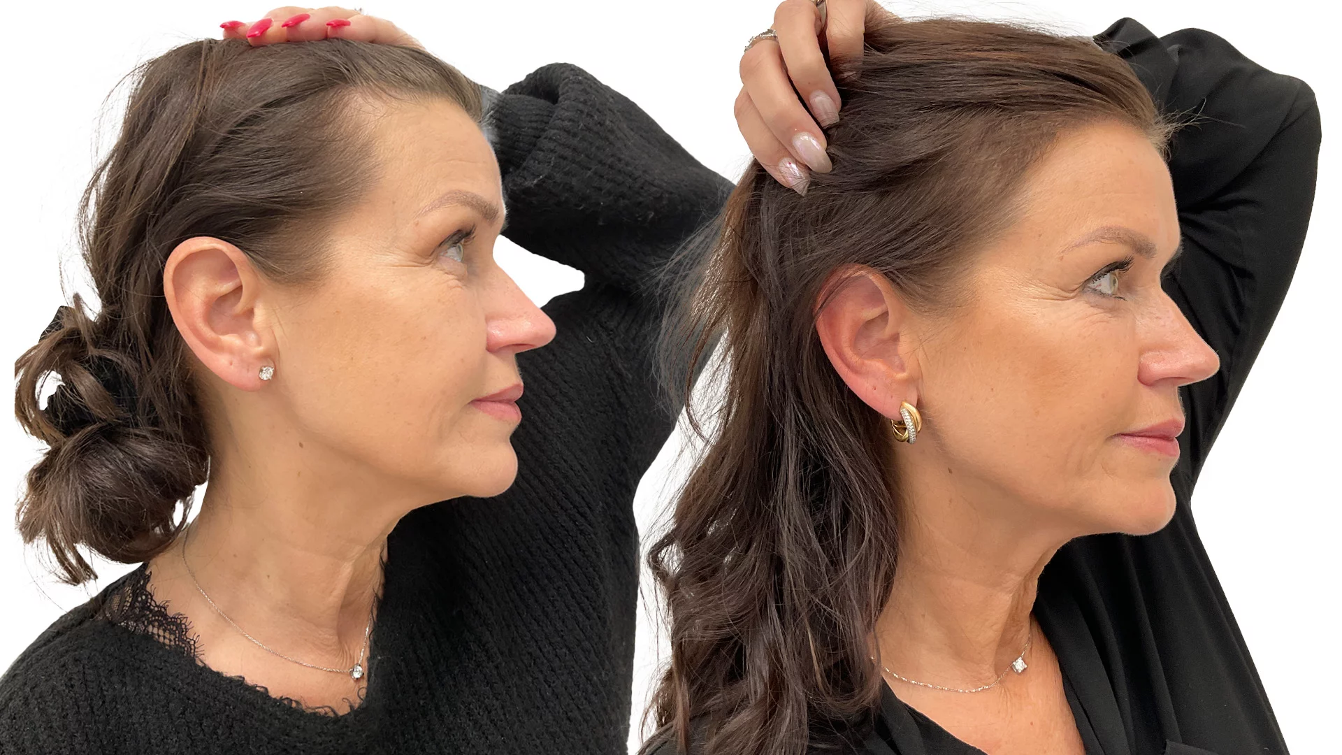 Lena – före och efter sin hårtransplantation