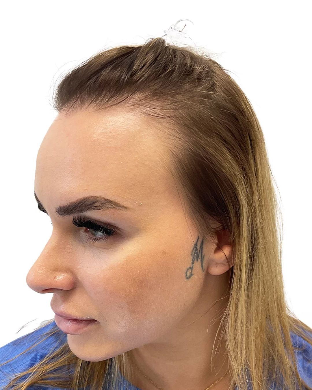 Kristine före hårtransplantationen