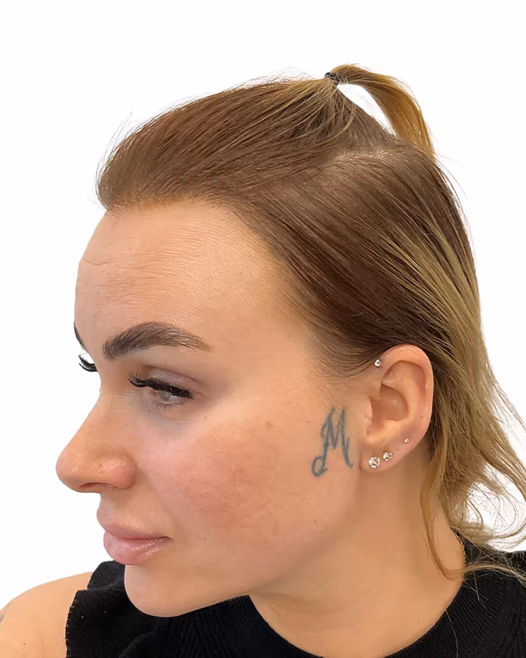 Kristine efter hårtransplantationen