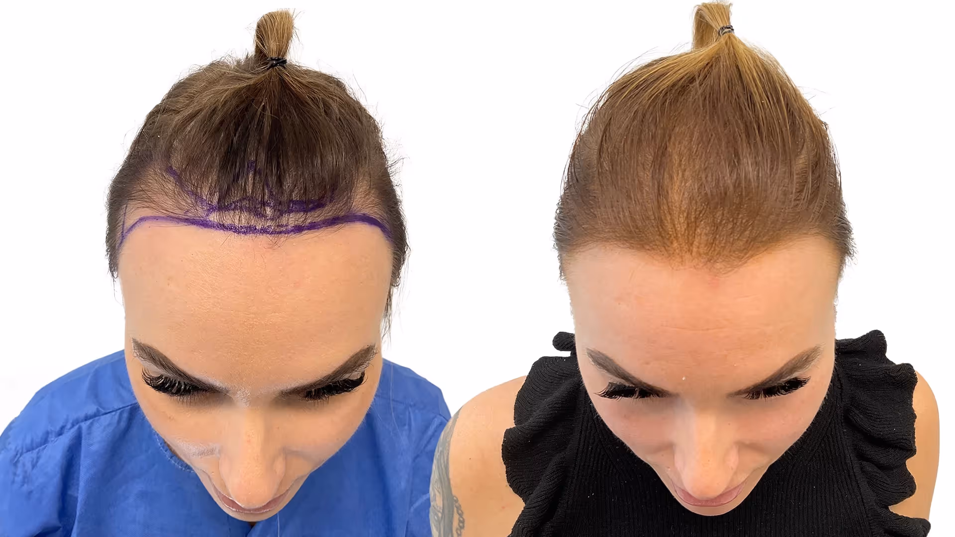 Kristine – före och efter sin hårtransplantation