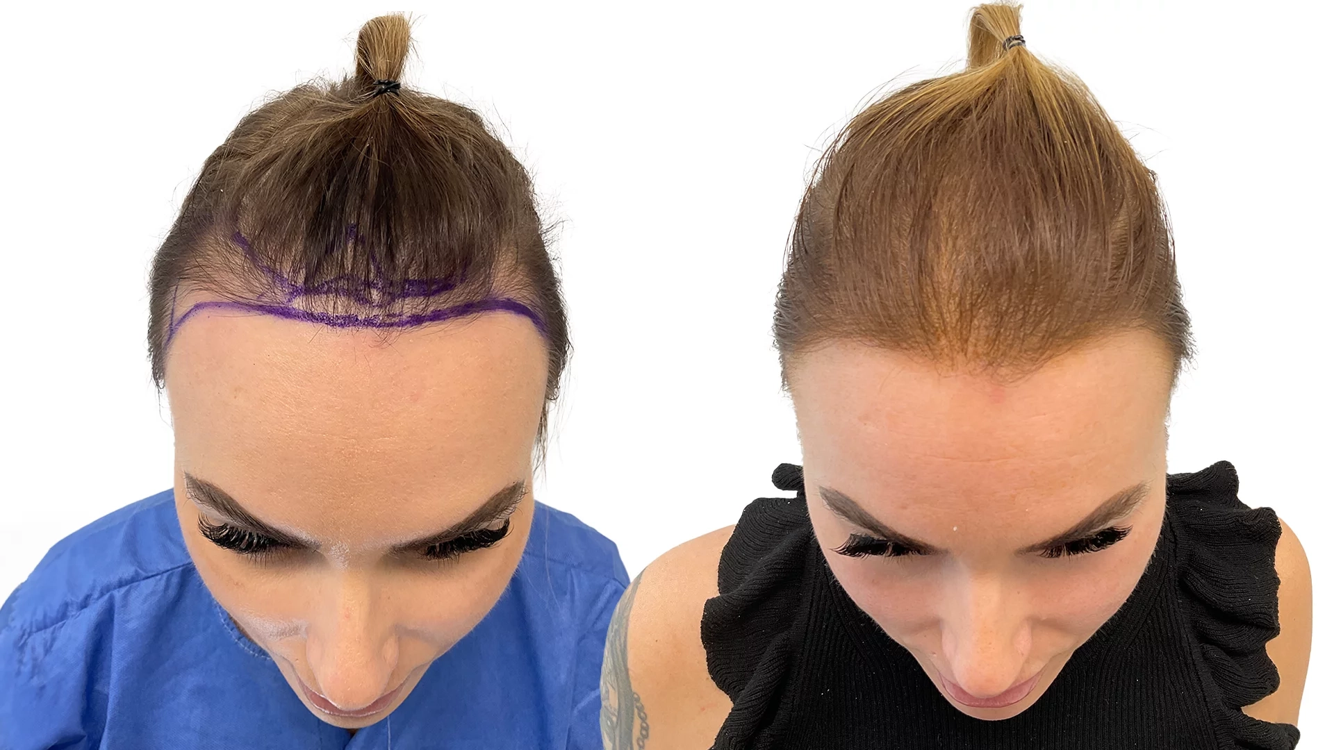 Kristine – före och efter sin hårtransplantation