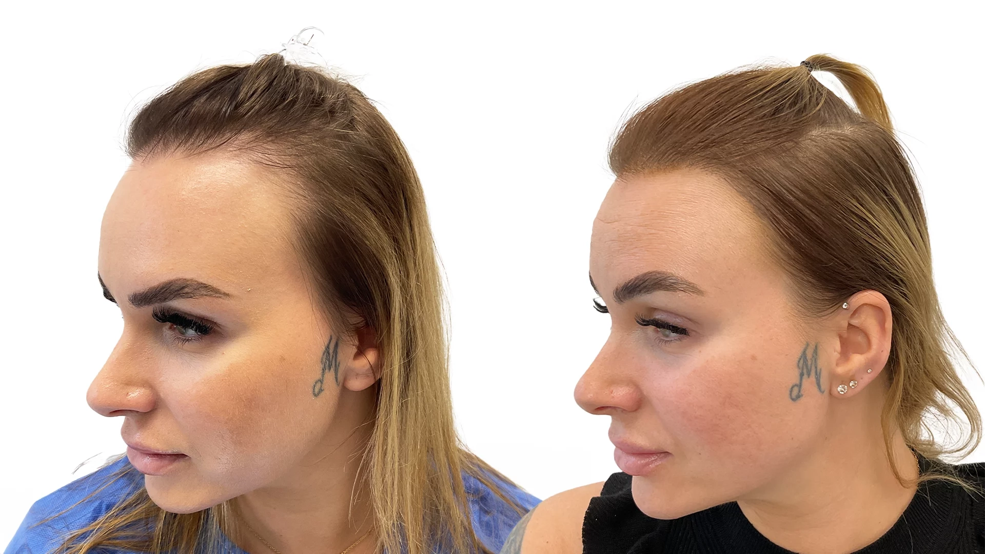 Kristine – före och efter sin hårtransplantation