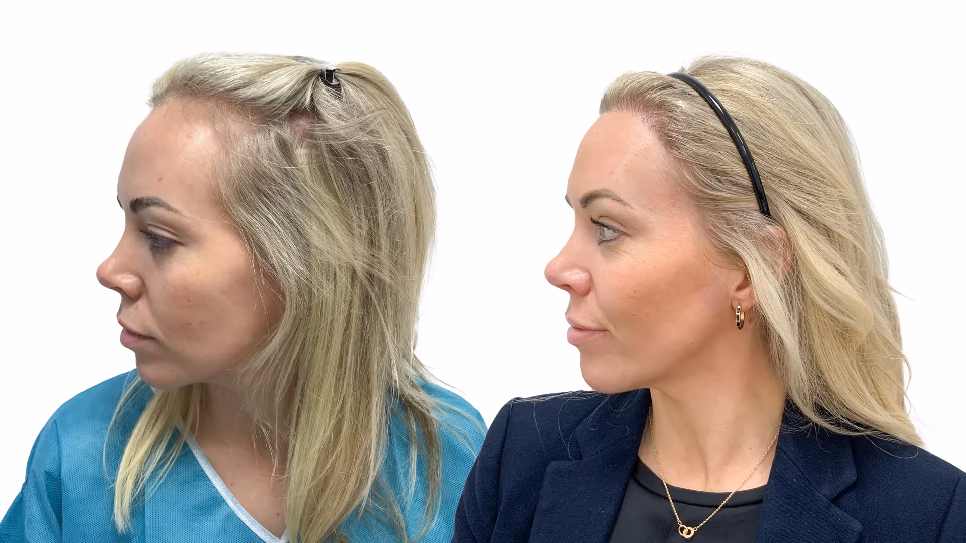 Karin – före och efter sin hårtransplantation