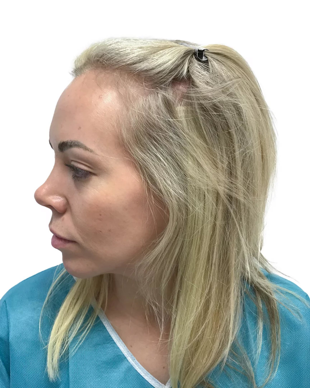 Karin före hårtransplantationen