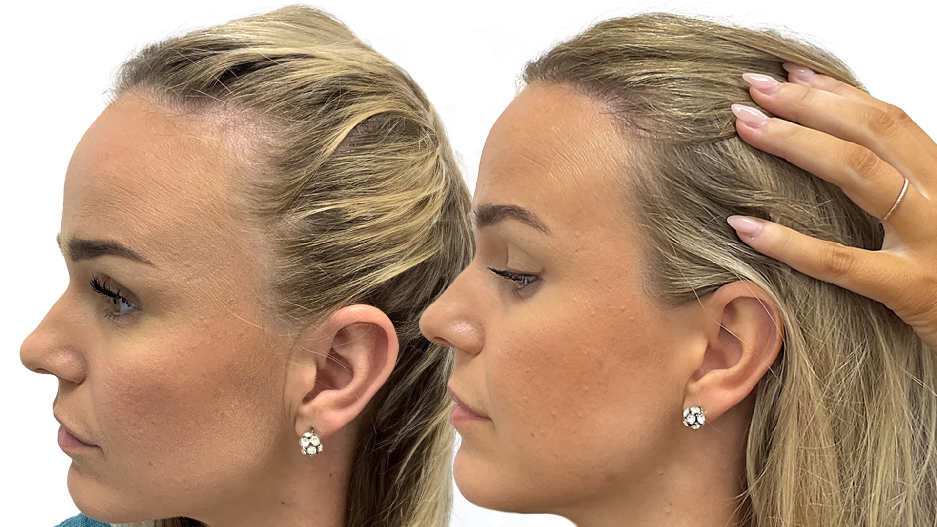 Kajsa – före och efter sin hårtransplantation