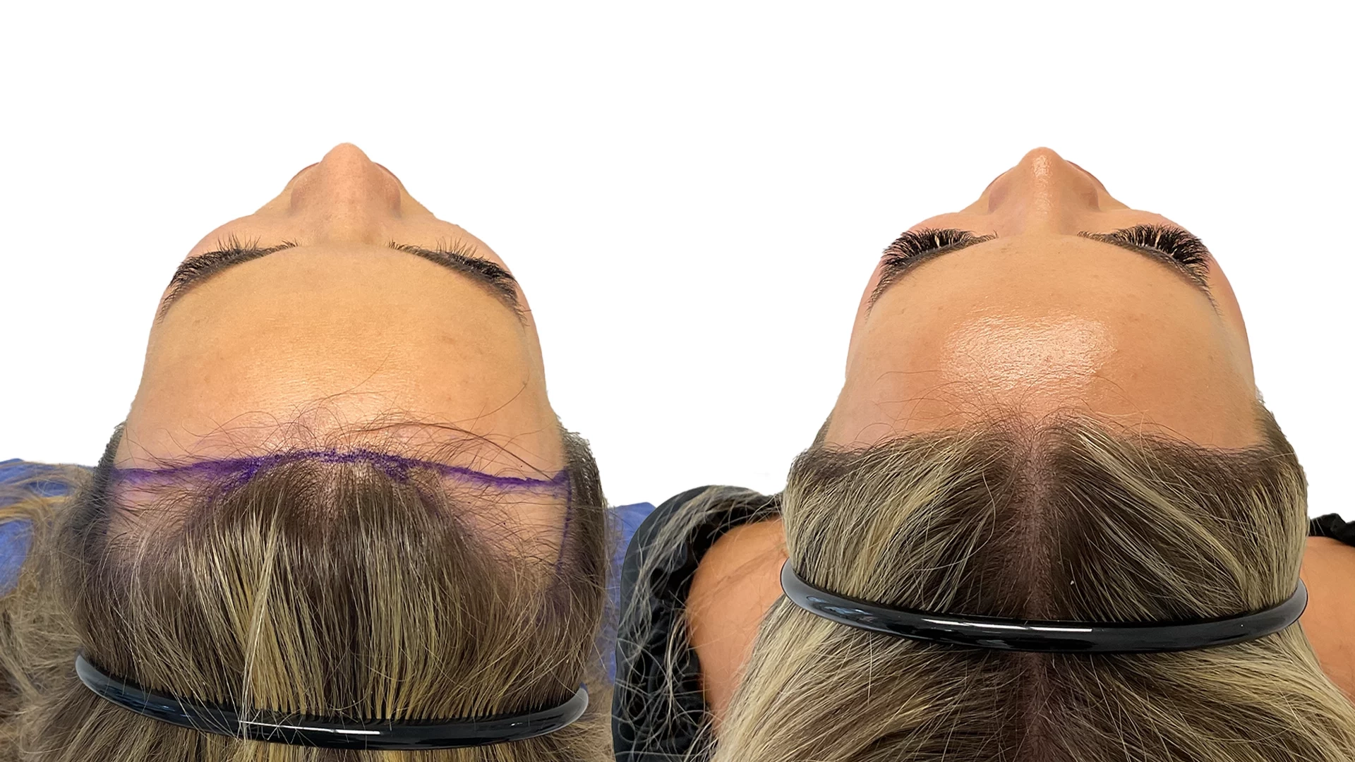 Julia – före och efter sin hårtransplantation