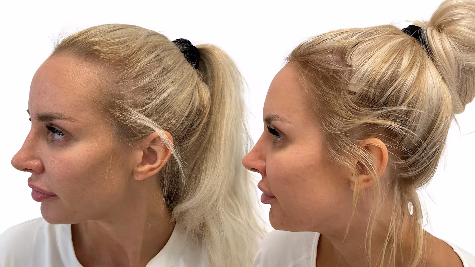 Julia – före och efter sin hårtransplantation
